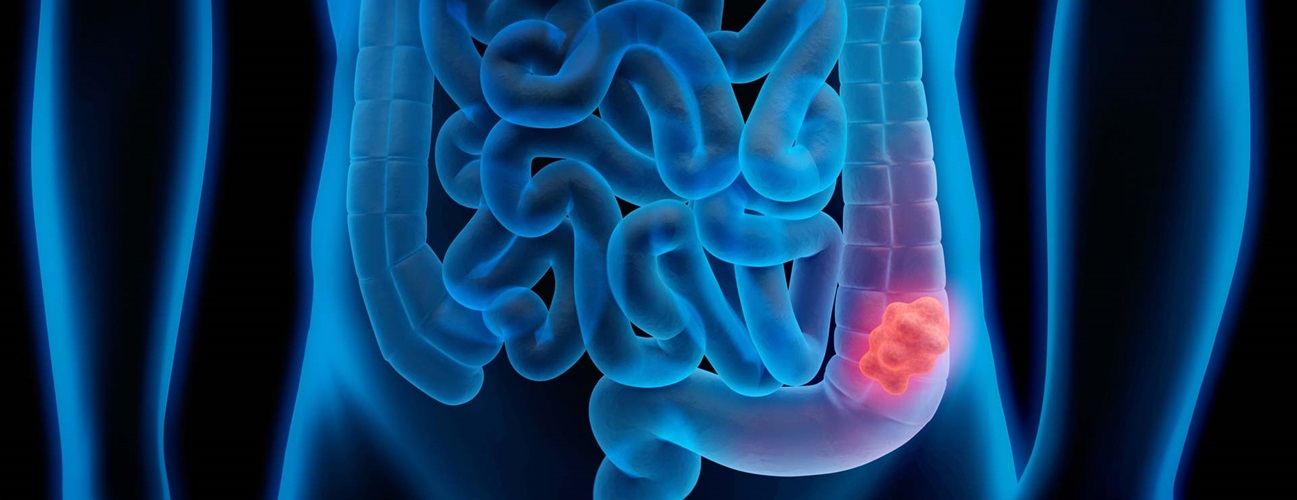 What is Colorectal Cancer?
