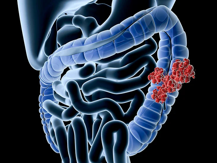 Colorectal Cancer Screening