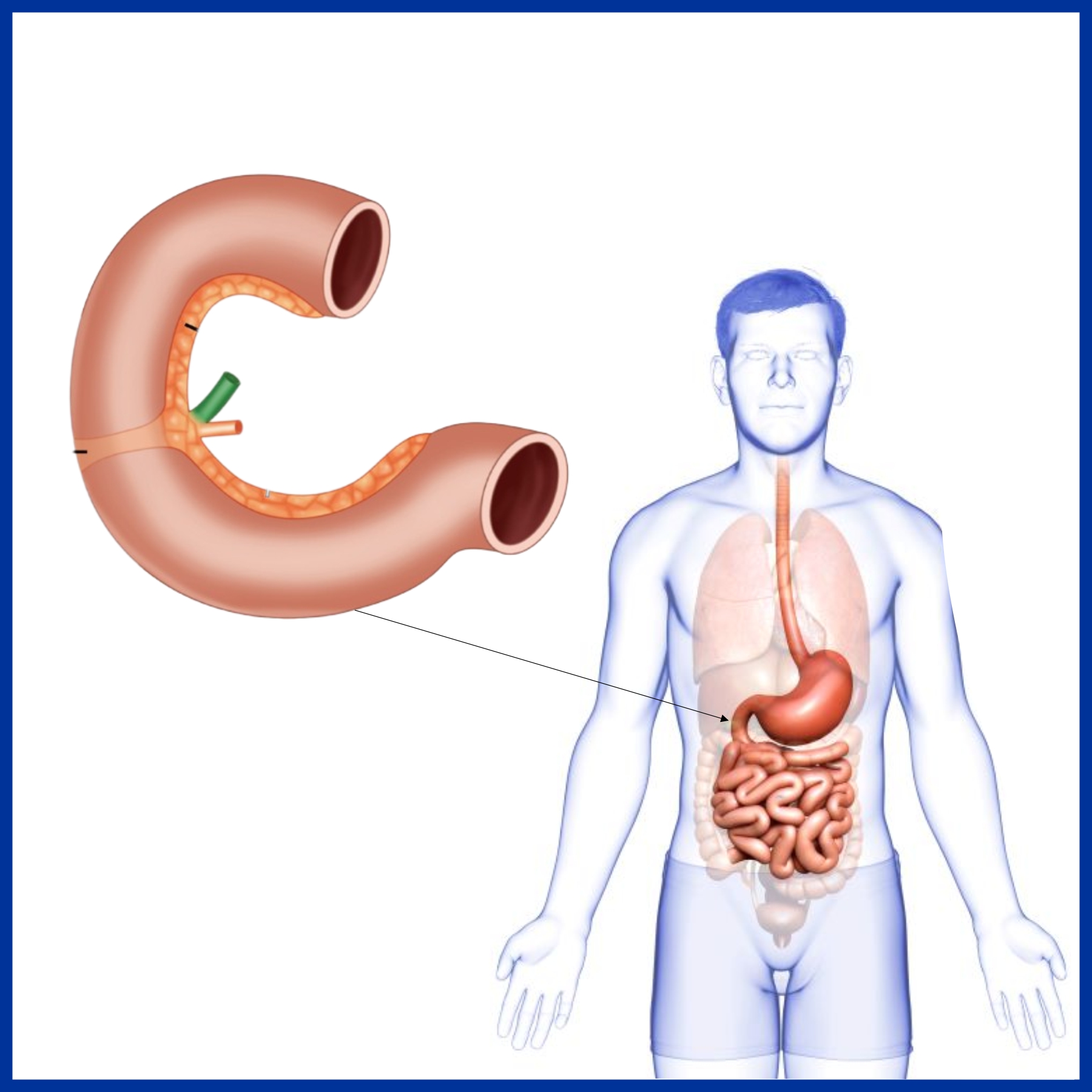 Duodenum Disease