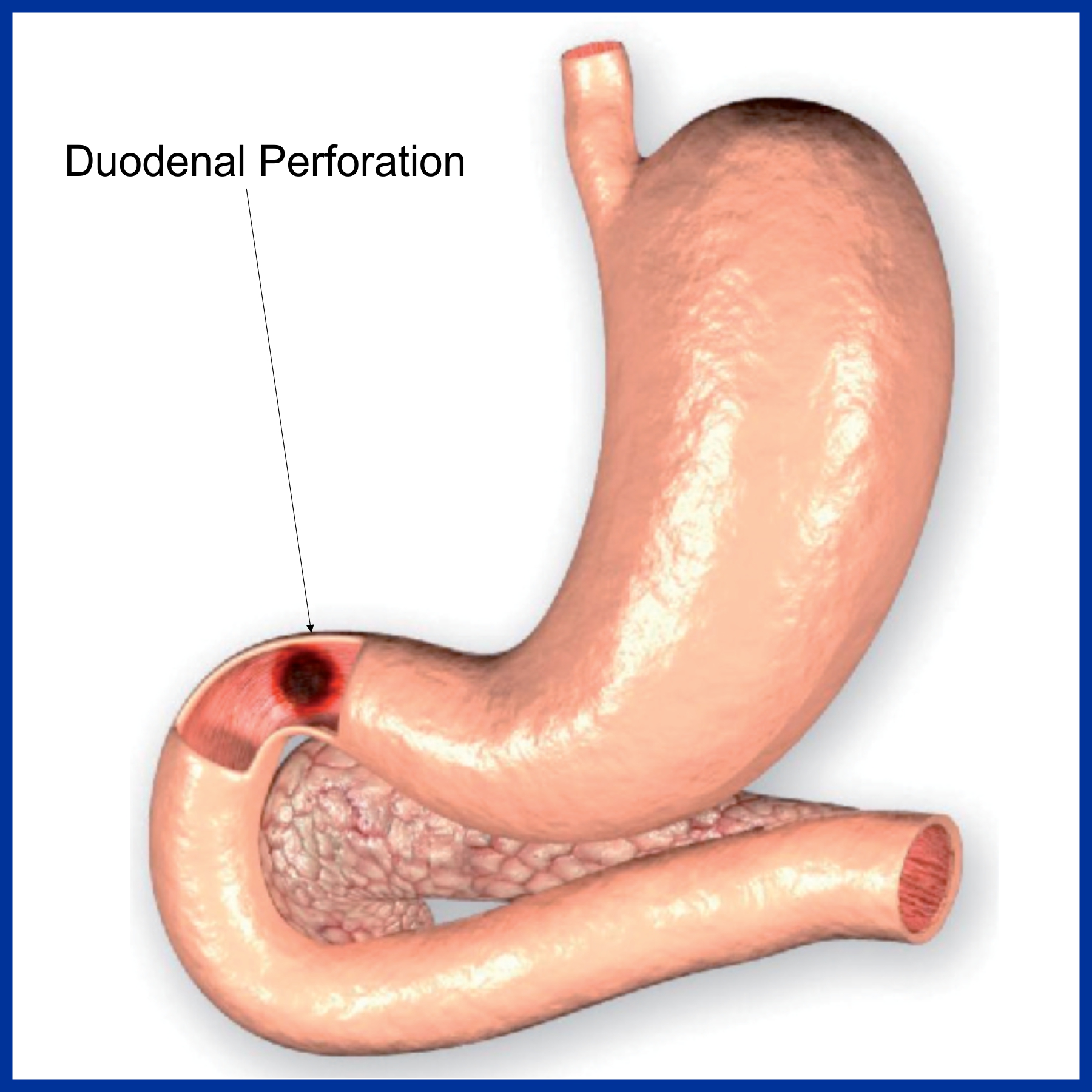 Duodenal Perforation