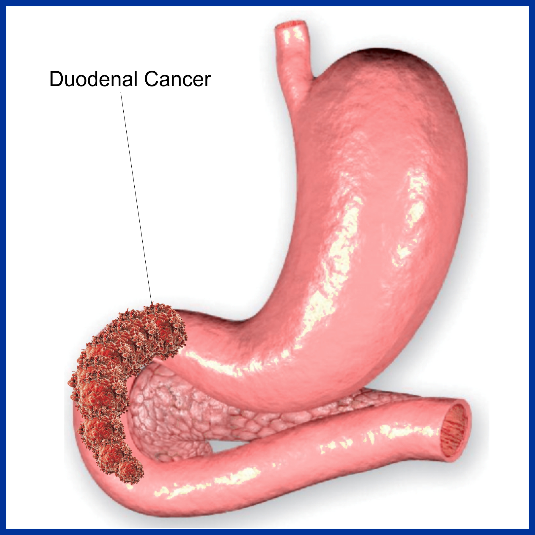 Cancer of Duodenum