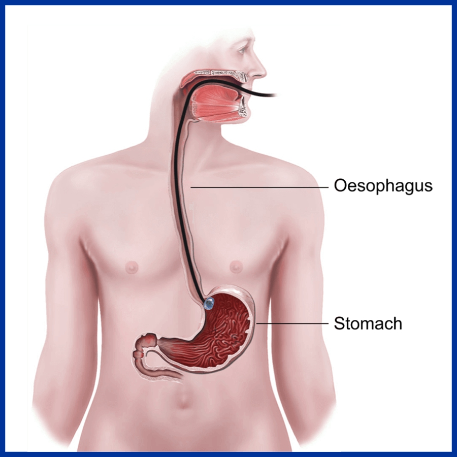 Esophagus Diseases