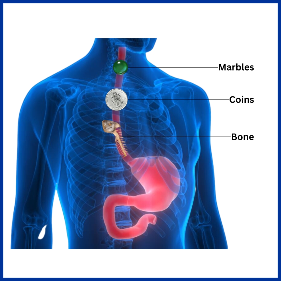 Foreign Body in Esophagus