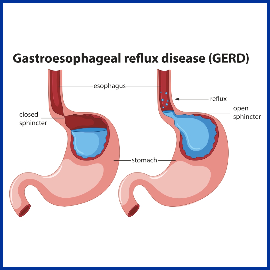 GERD (Gastro Esophageal Reflux Disease)