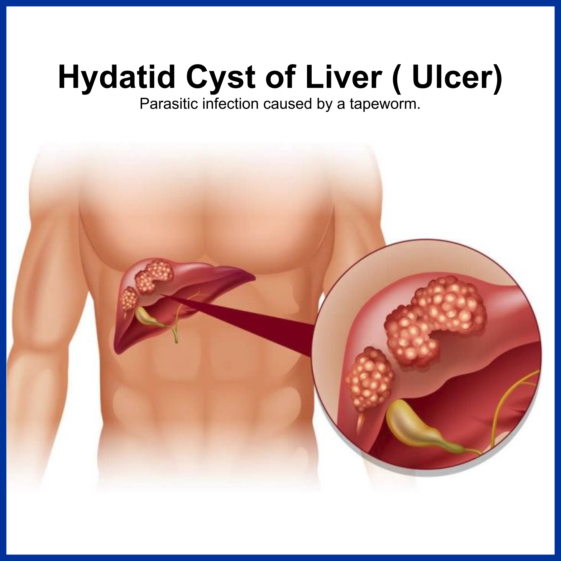 Hydatid Cyst of Liver