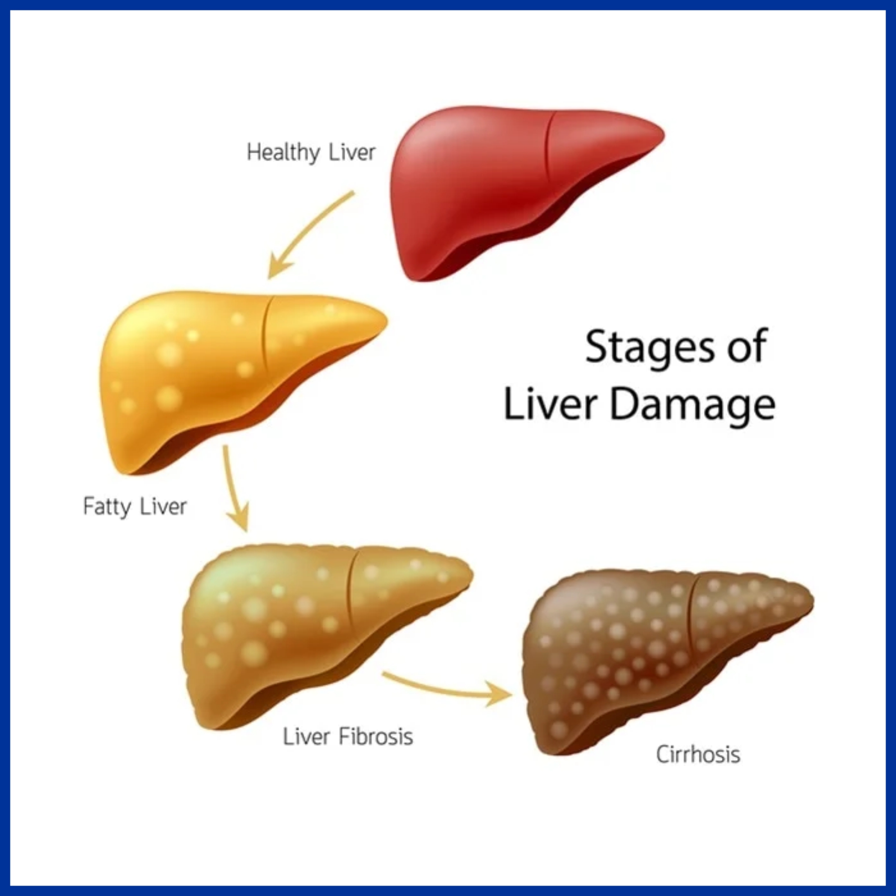 Cirrhosis of Liver