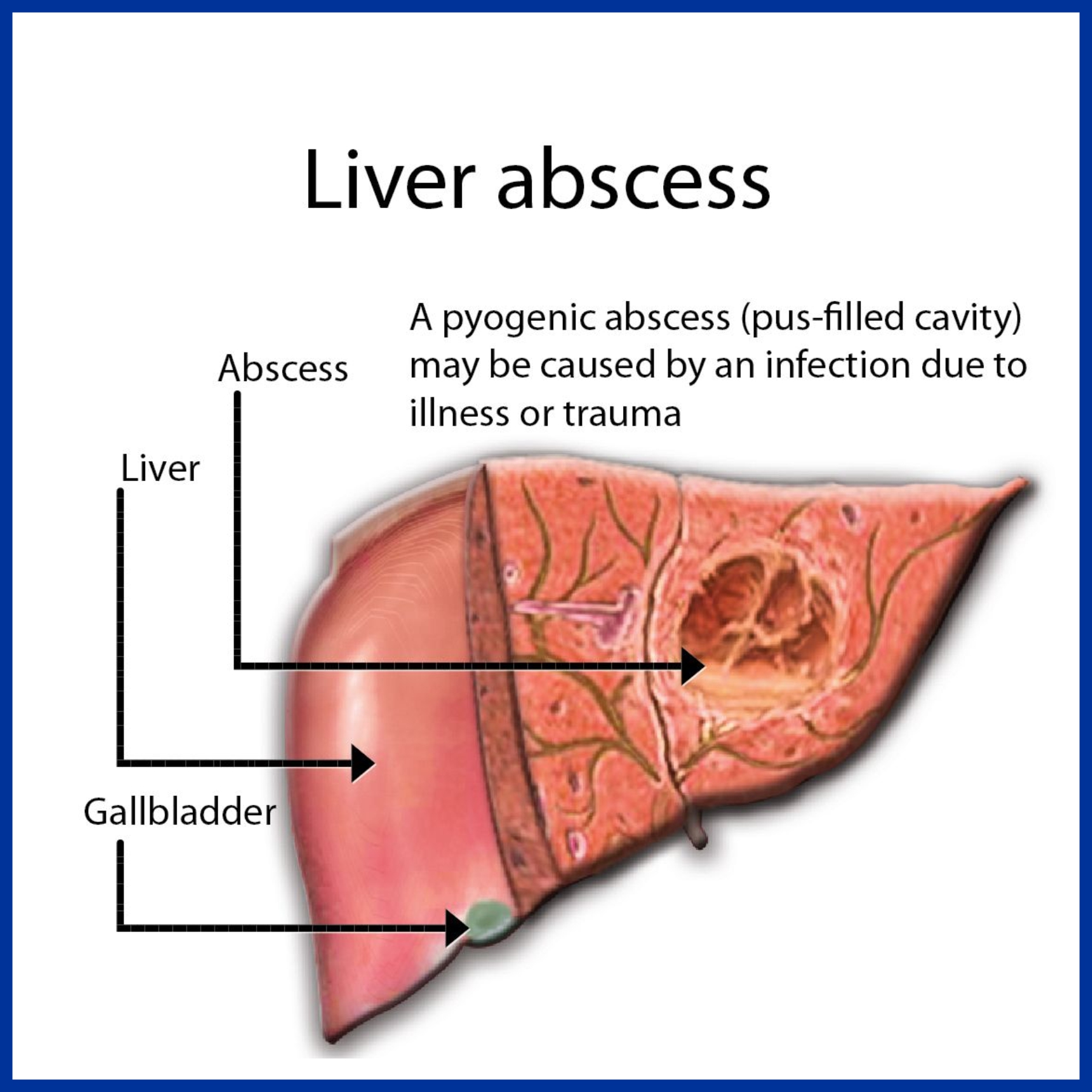 Liver Abscess