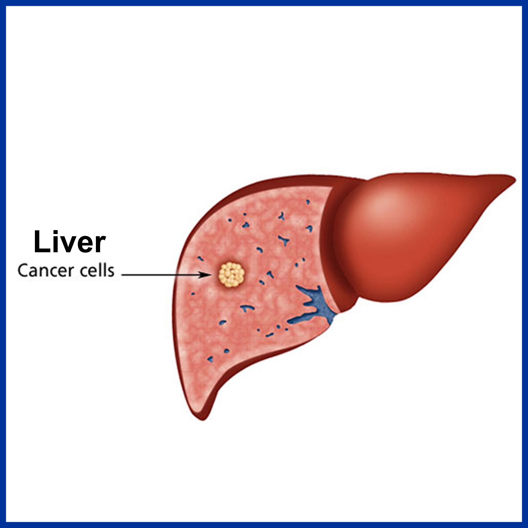 Cancer of Liver