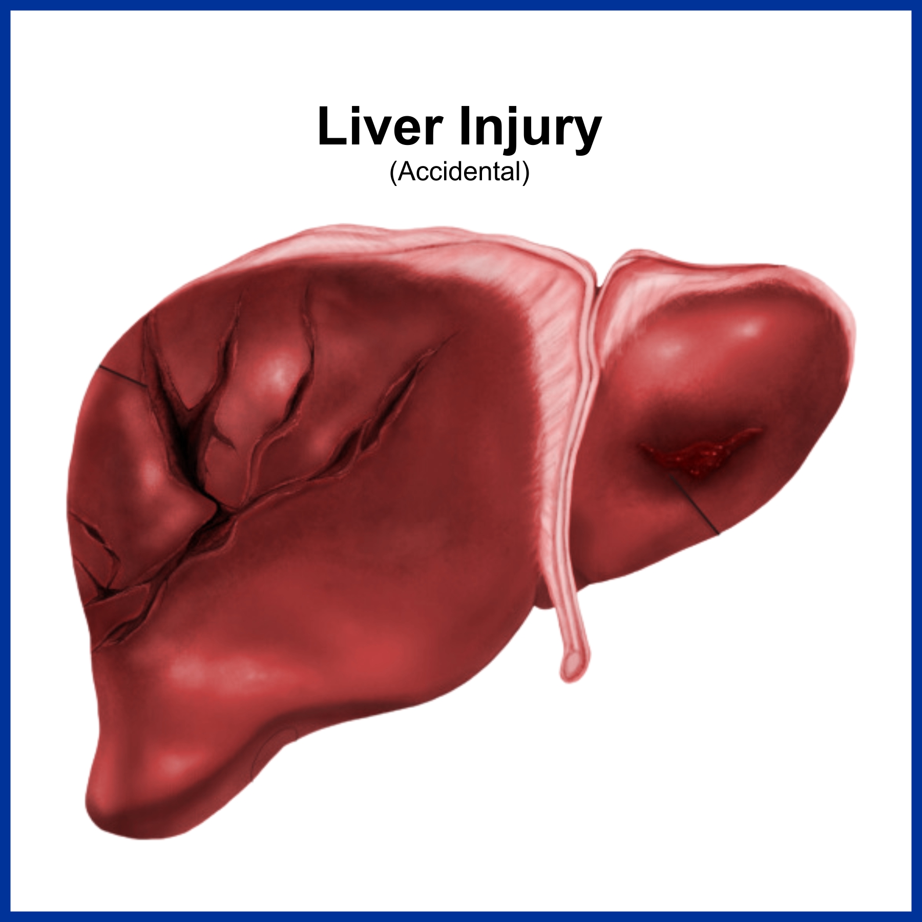 Liver Injury