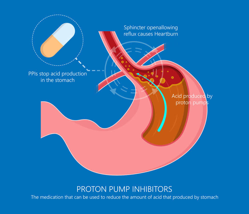 Long term acid suppressant medications – Proton pump inhibitors (PPI’s): Concerns and Care