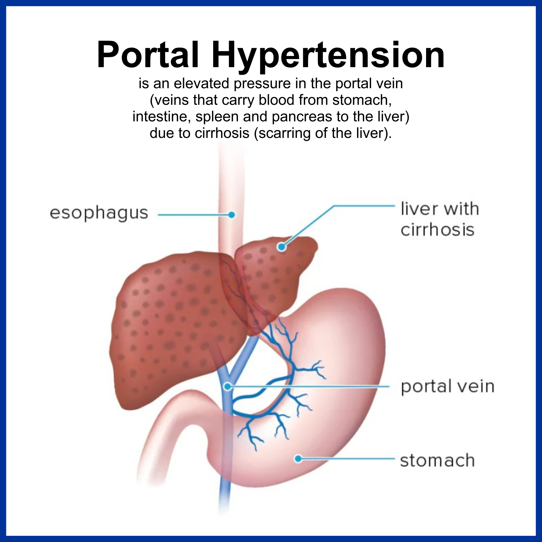 Portal Hypertension