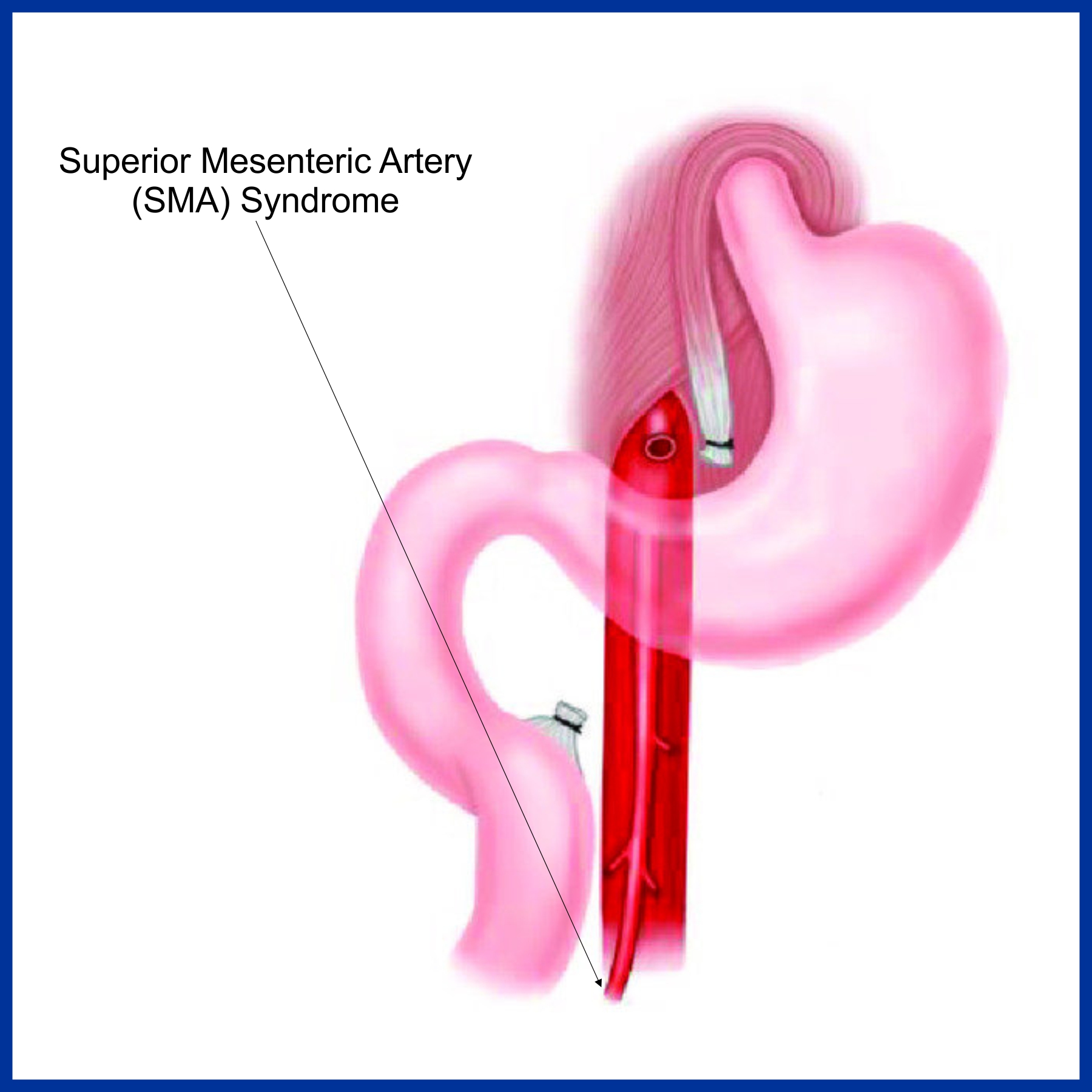 SMA Syndrome