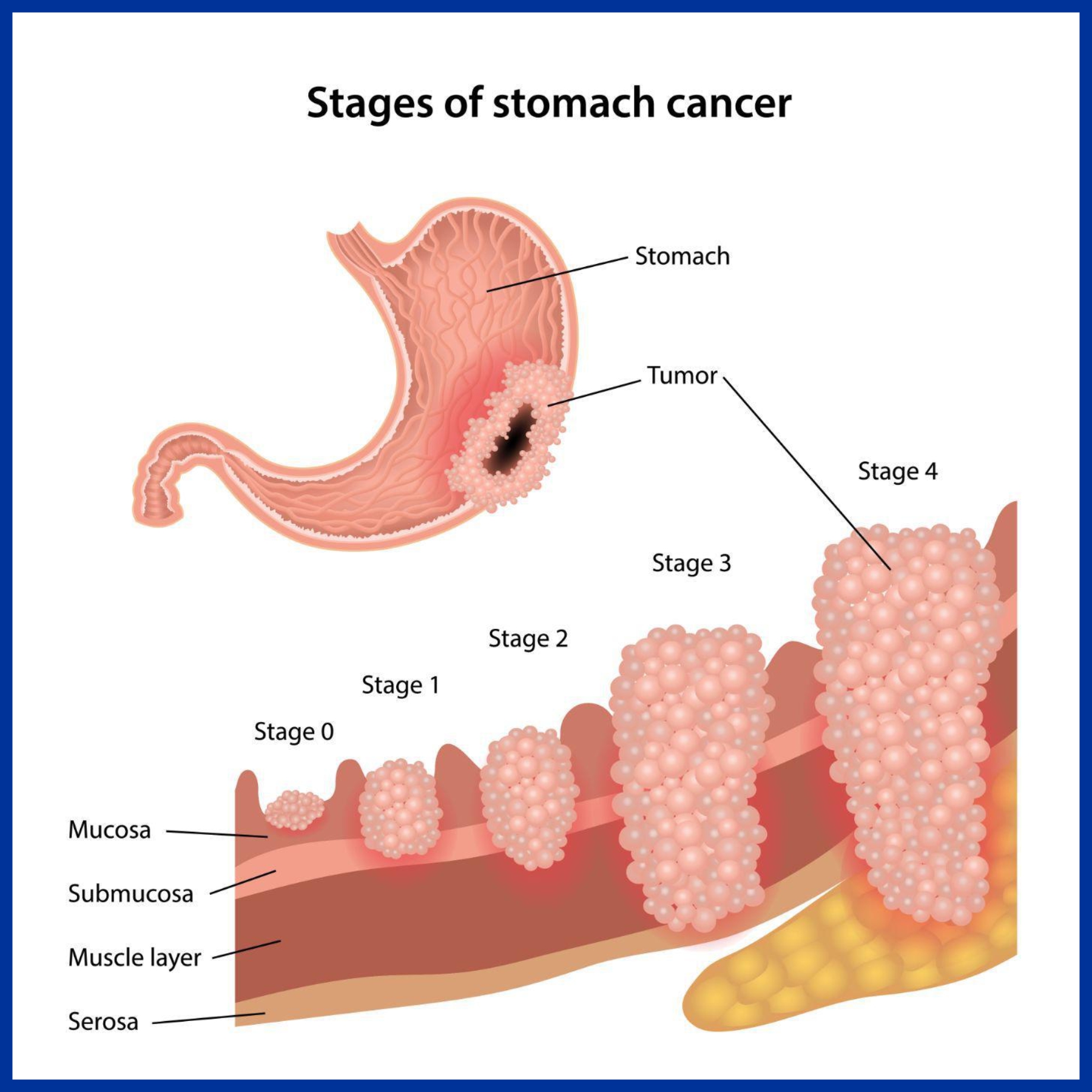 Cancer of Stomach