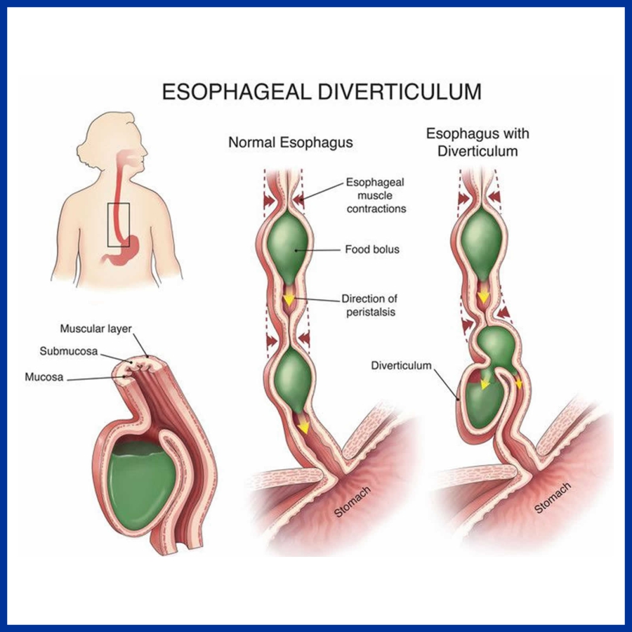 Esophageal Diverticulum
