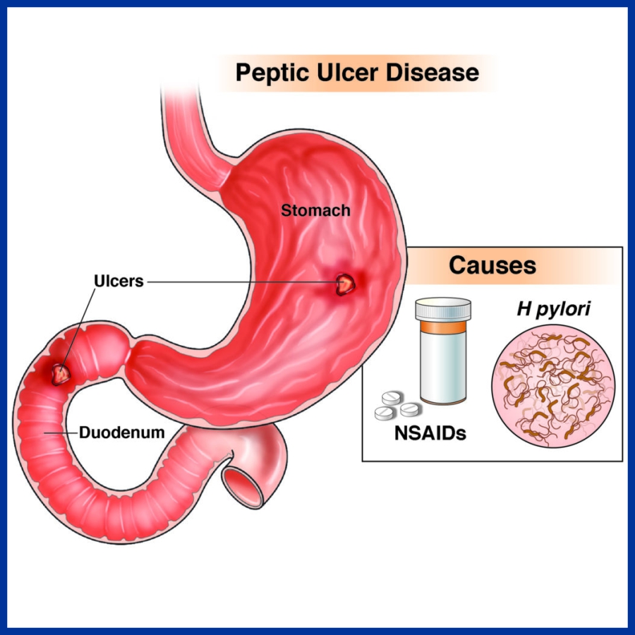 Acid peptic disease