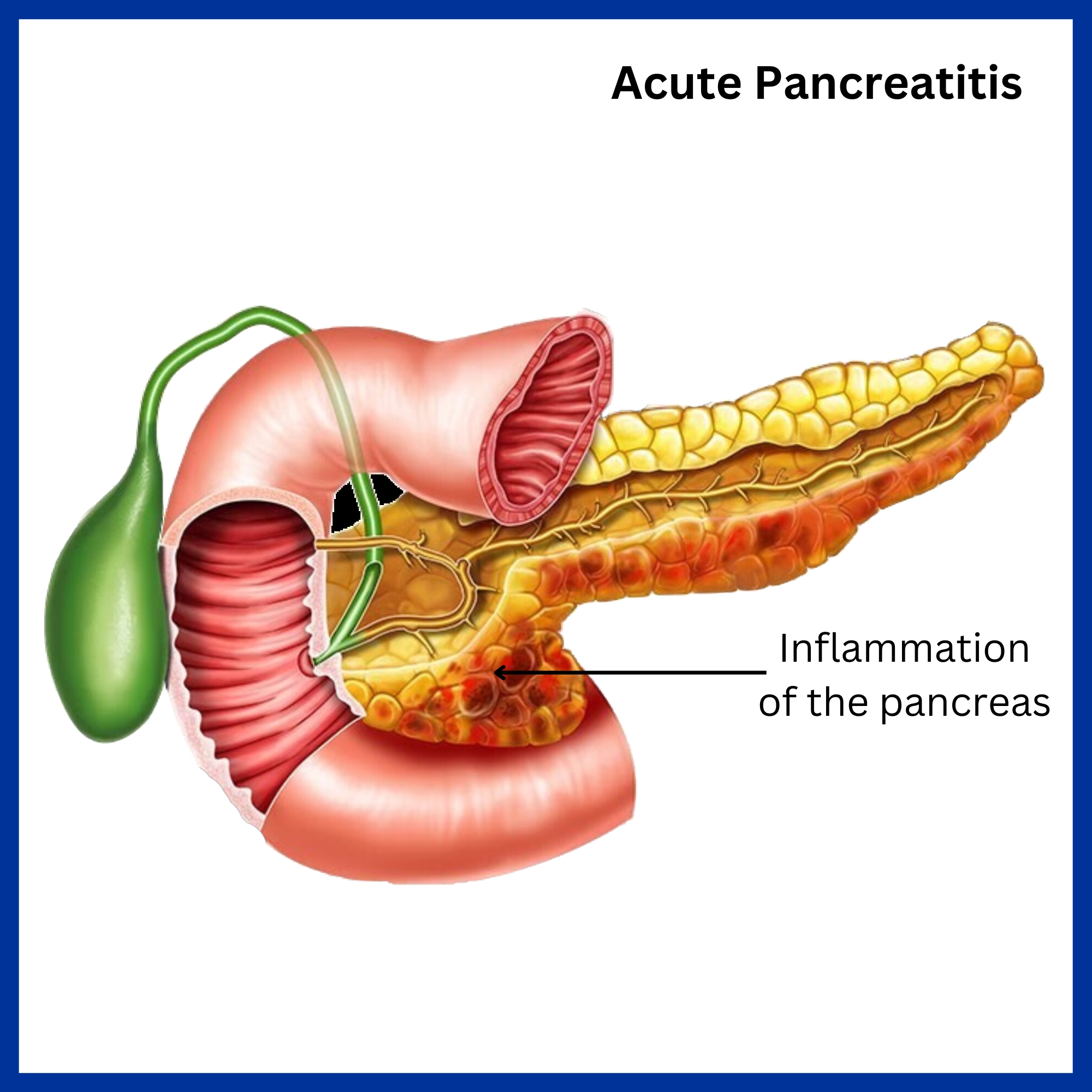 Acute Pancreatitis