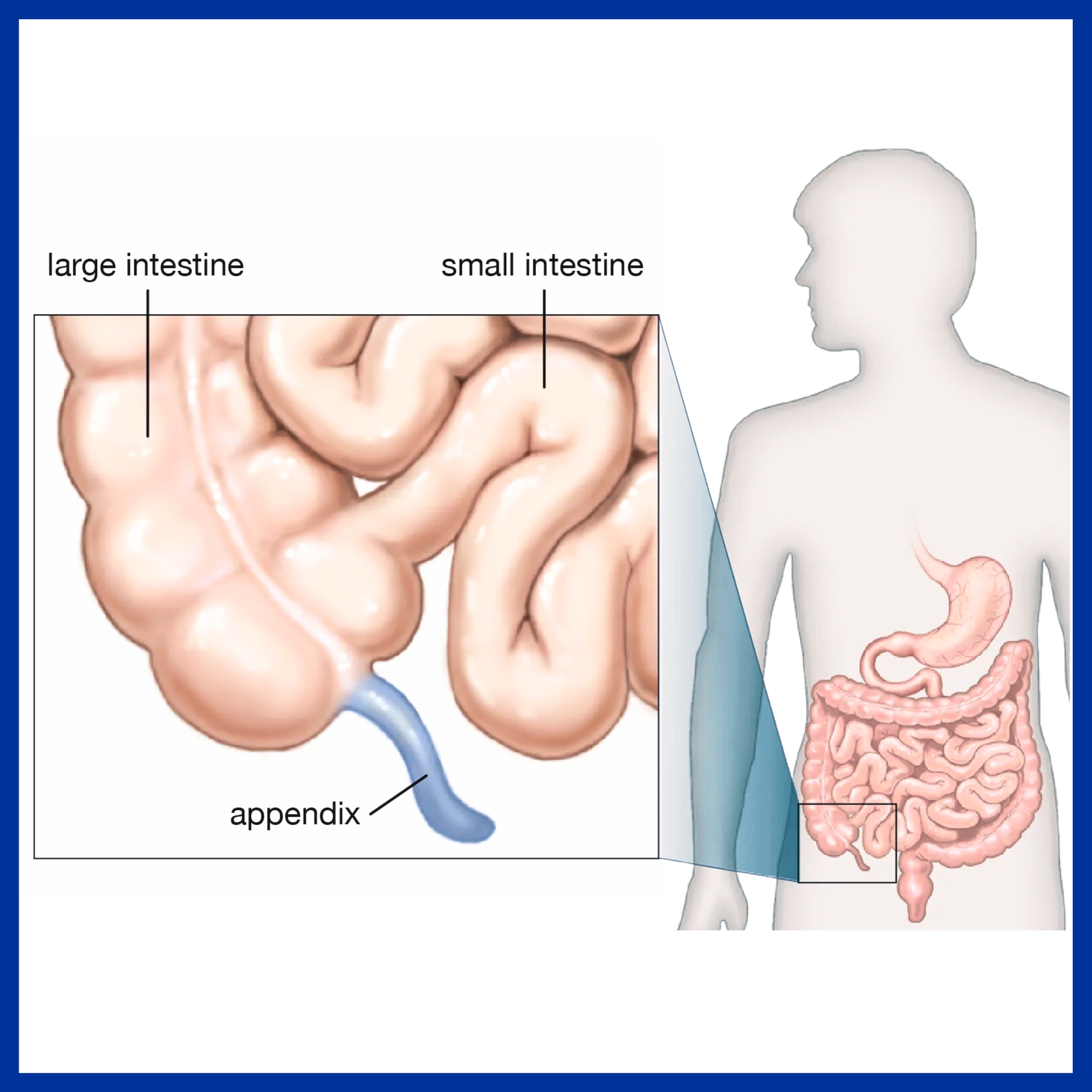 Appendix Diseases
