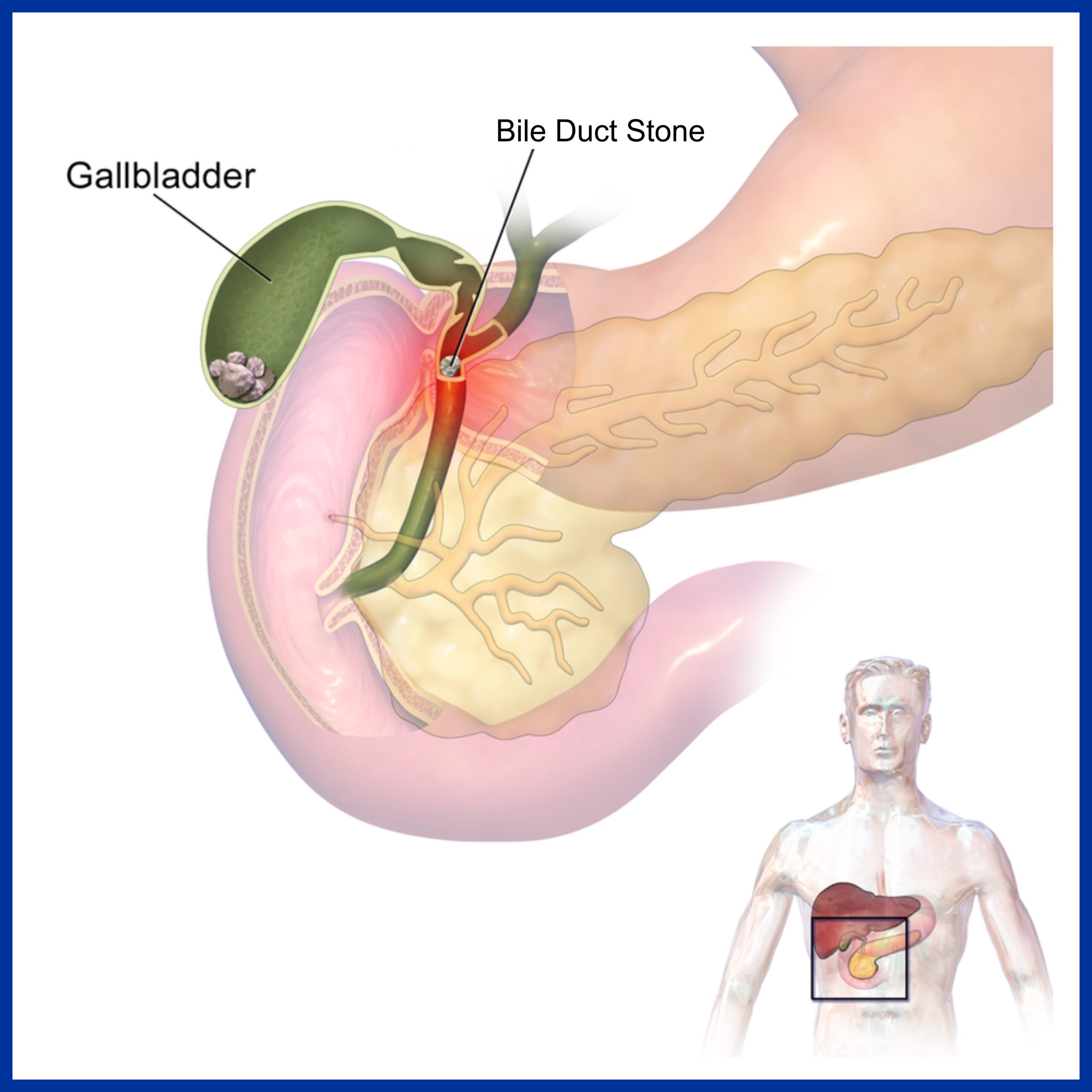 Bile duct stone