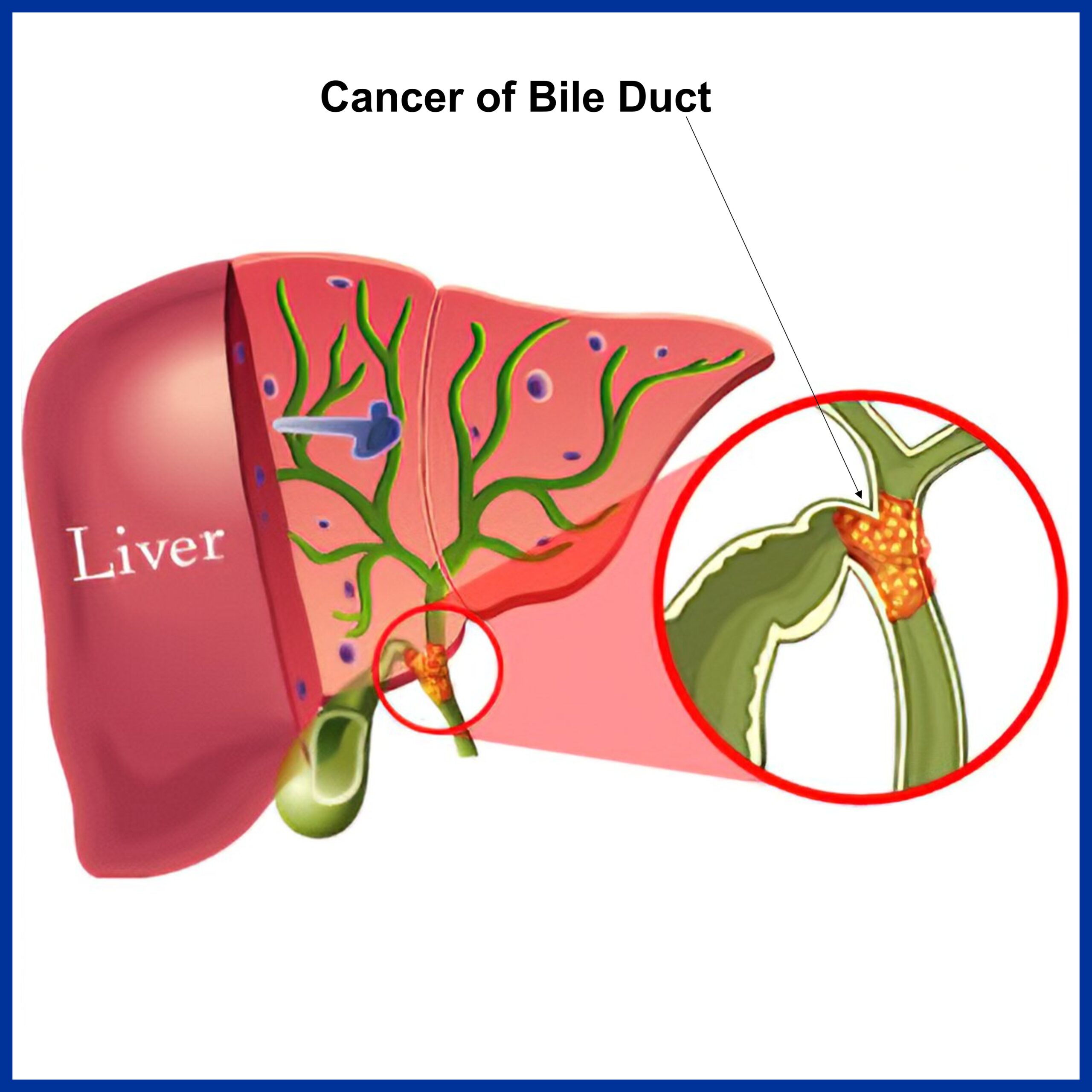 Cancer of Bile Duct