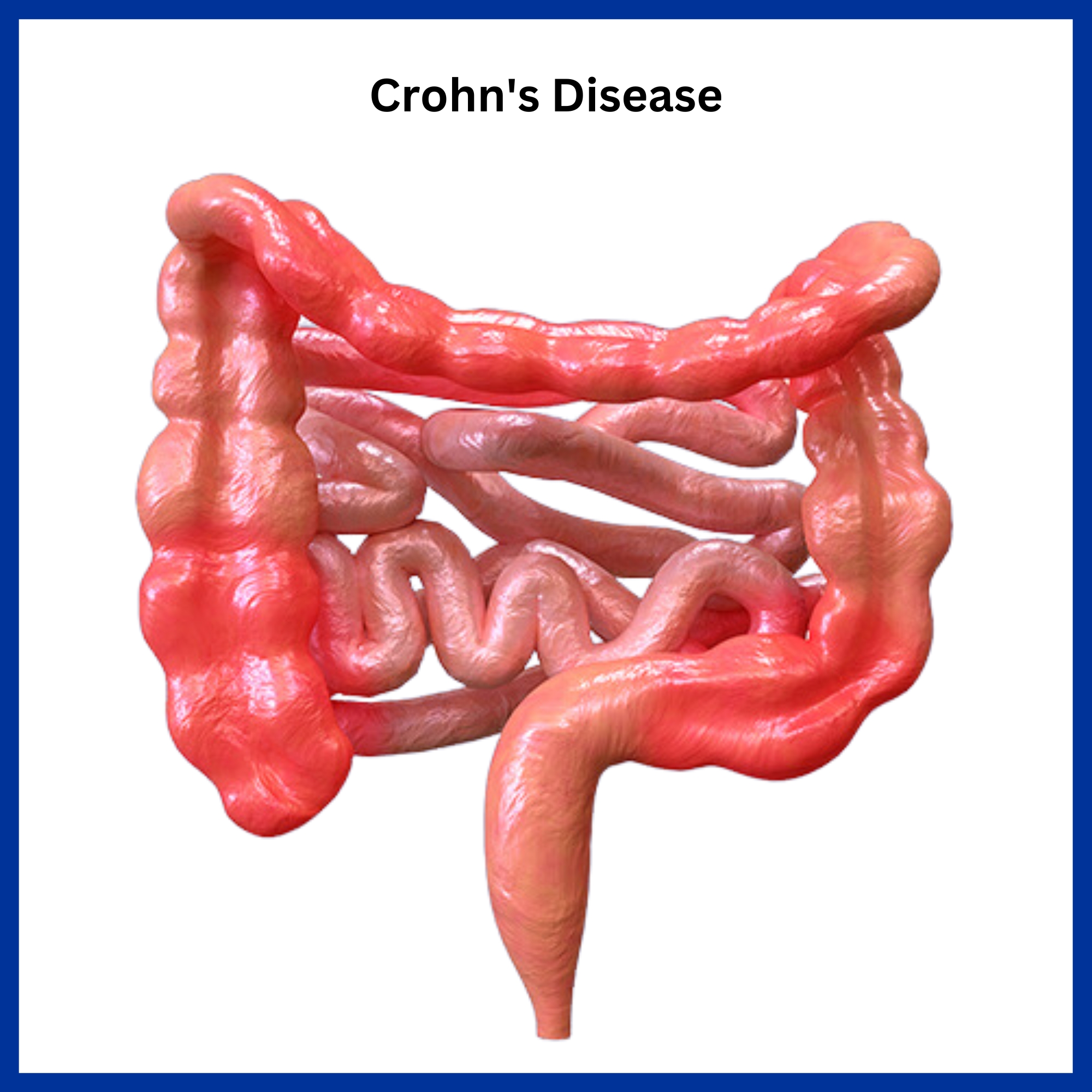 Crohn's Disease