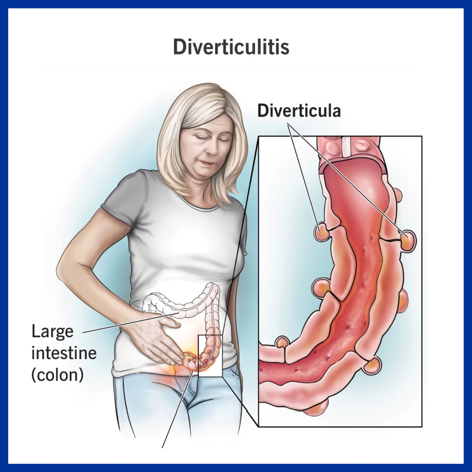 Large Intestine Disease - Best Gastroenterology Hospital in India