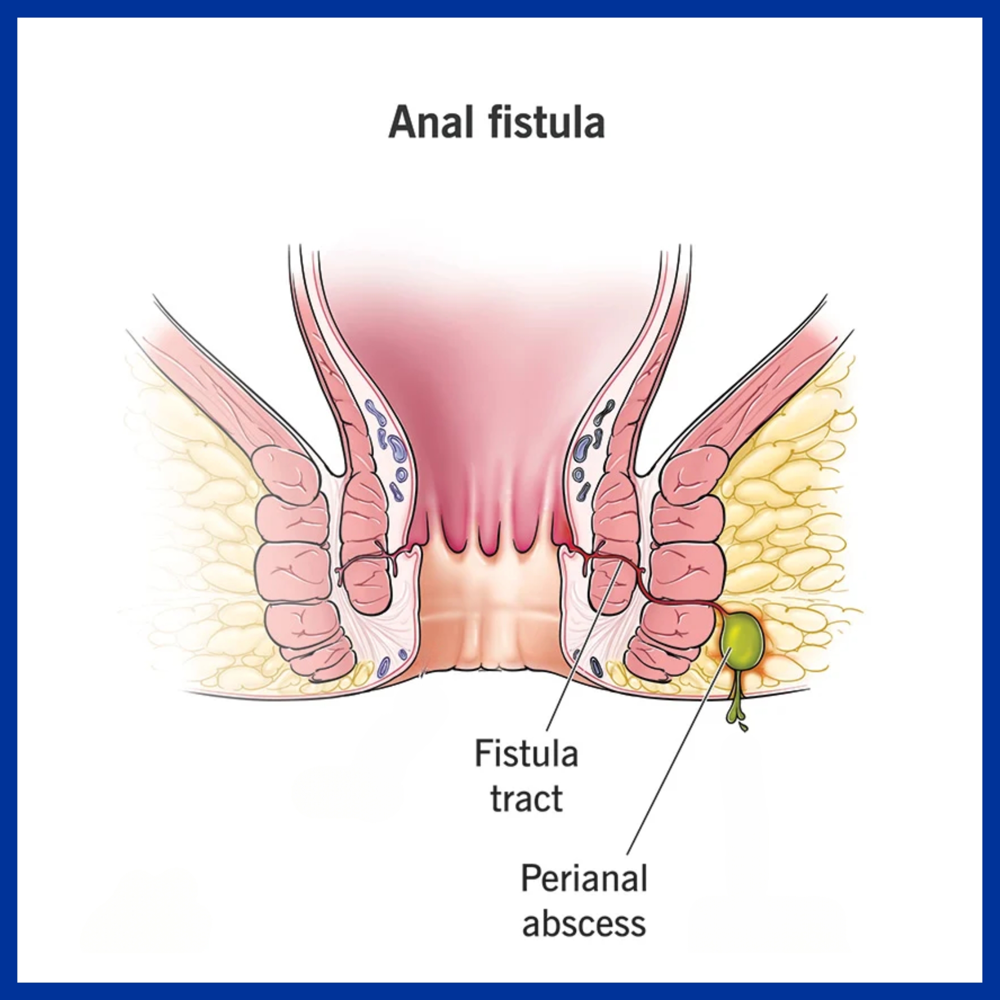 Fistula in ANO