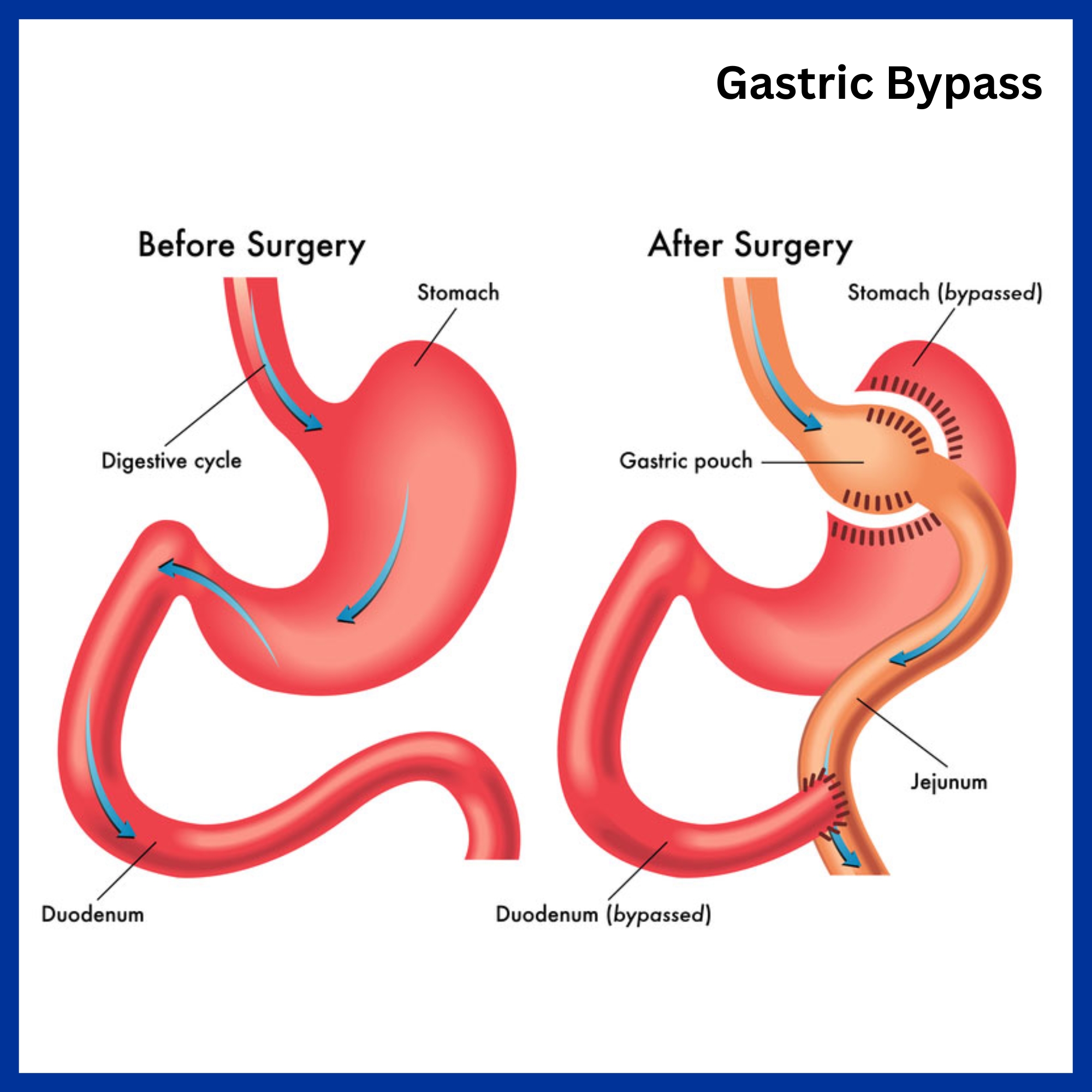 Gastric Bypass