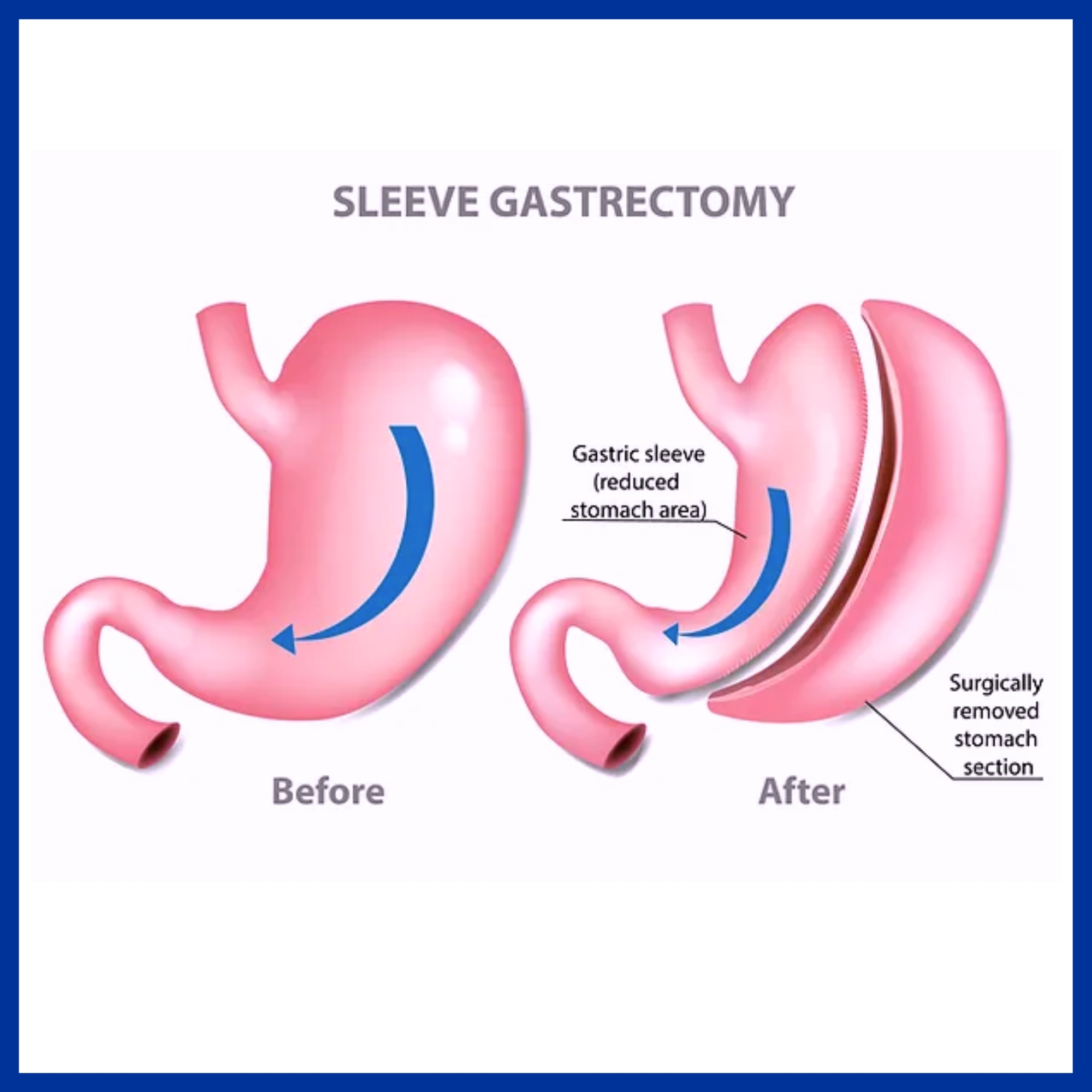 Gastric Sleeve