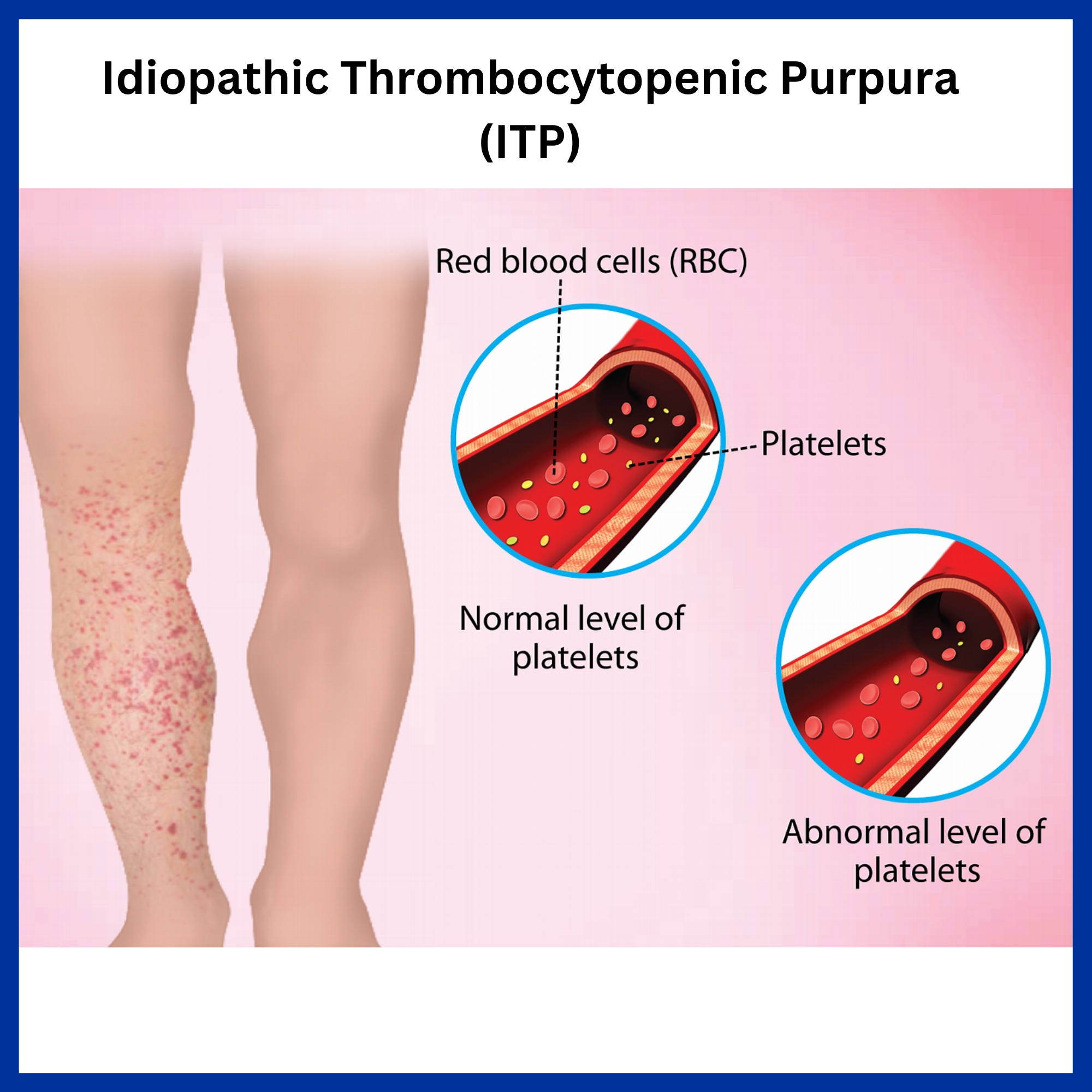 Idiopathic Thrombocytopenic Purpura