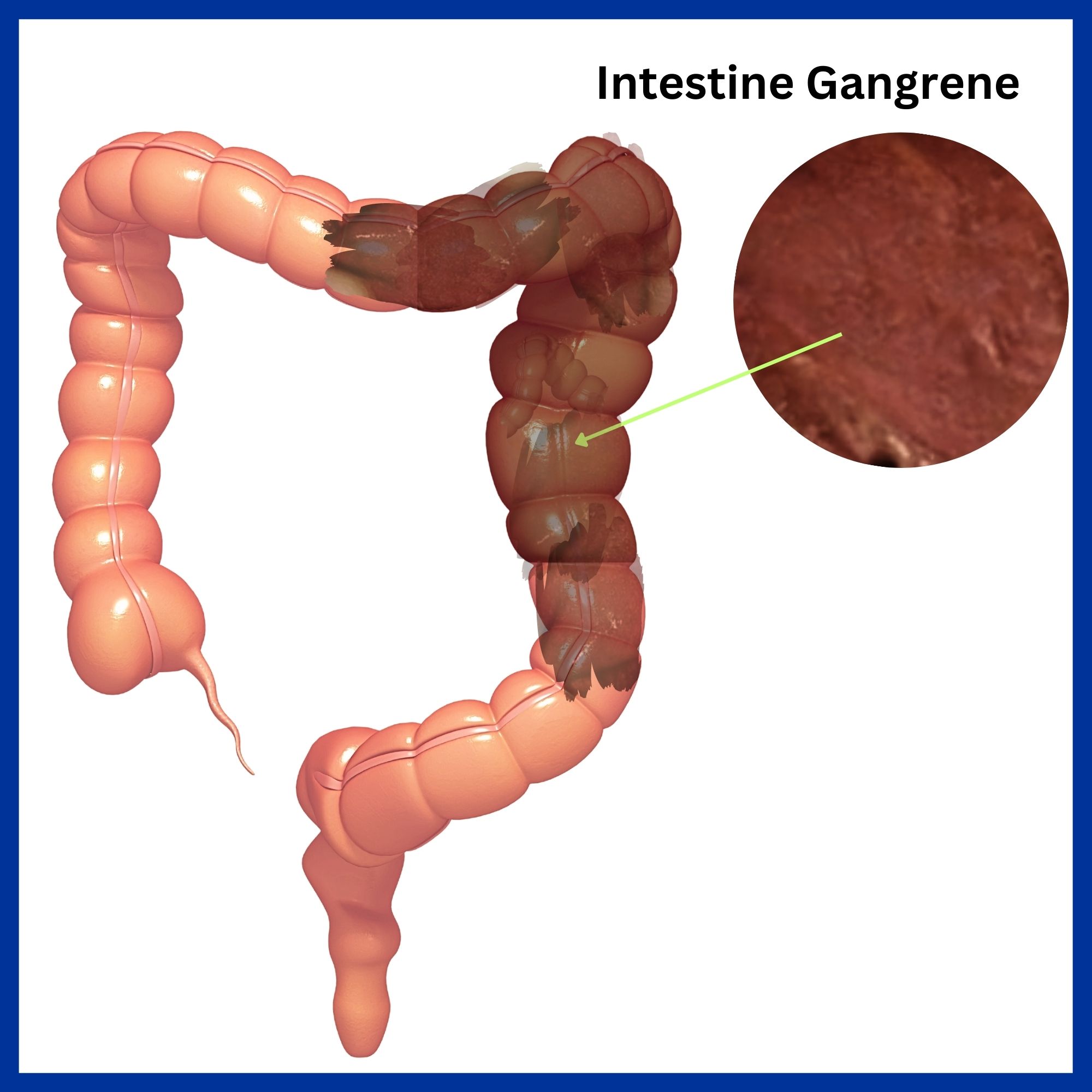 Intestinal Gangrene