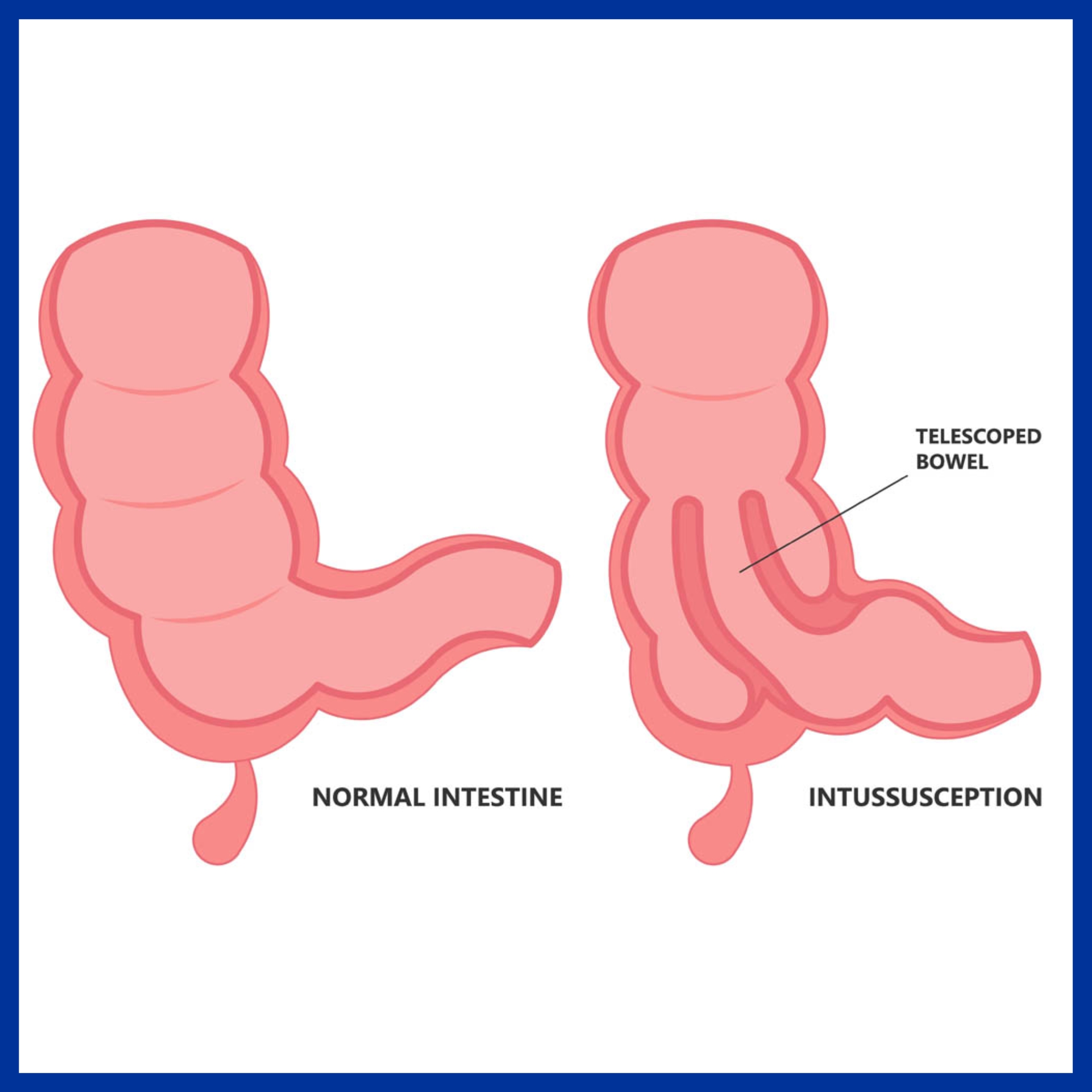 Intestinal Intussusception