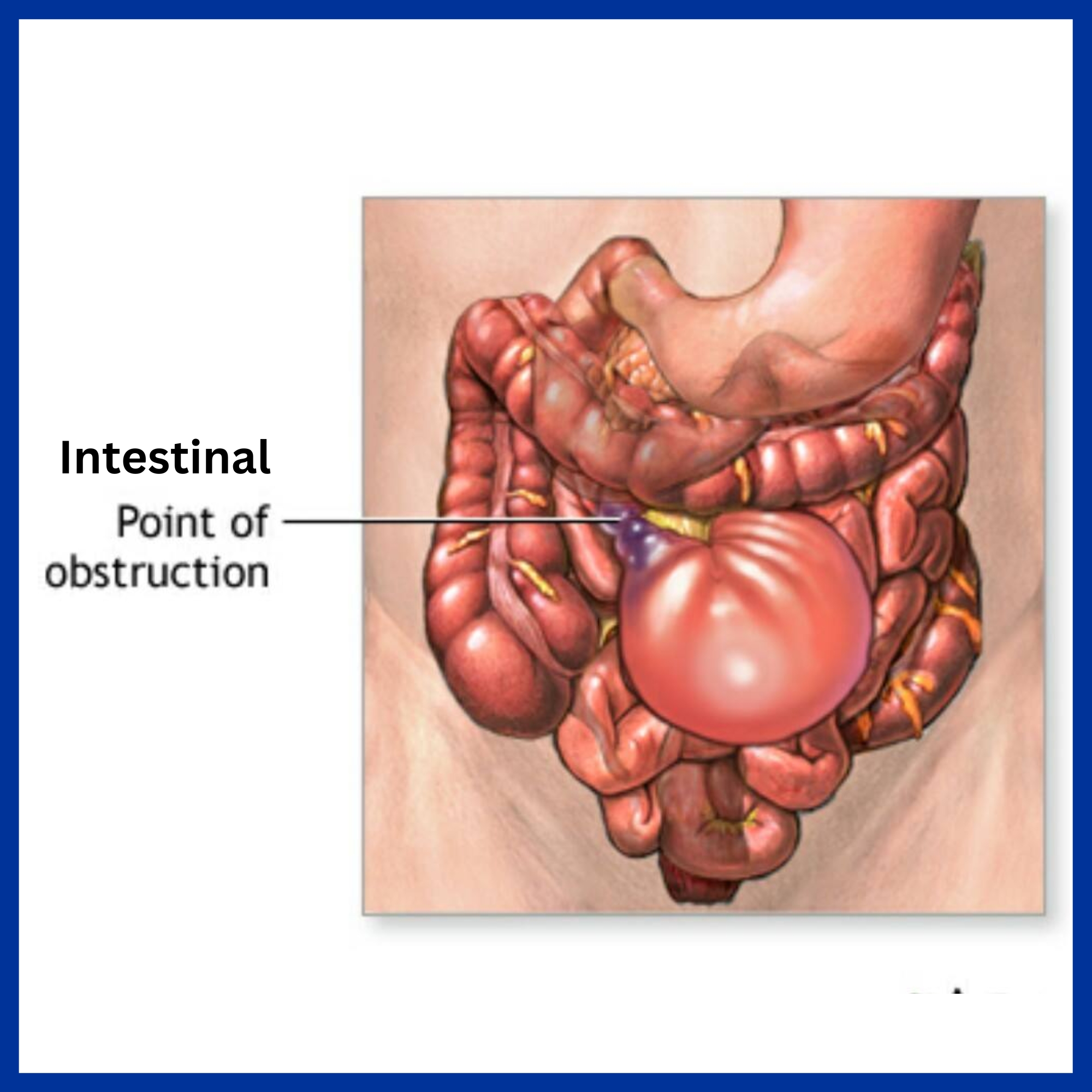 Intestinal Obstruction