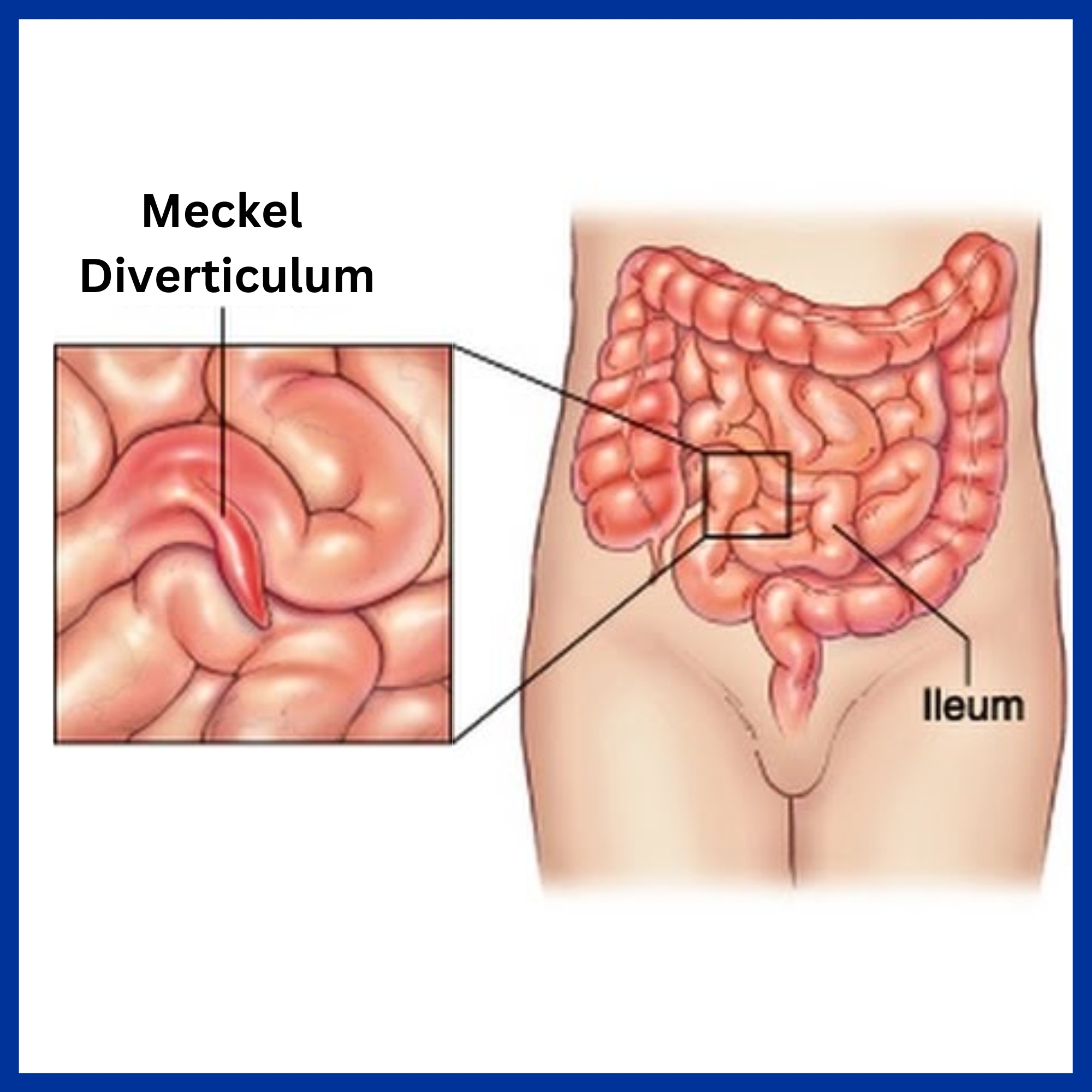 Meckel Diverticulum