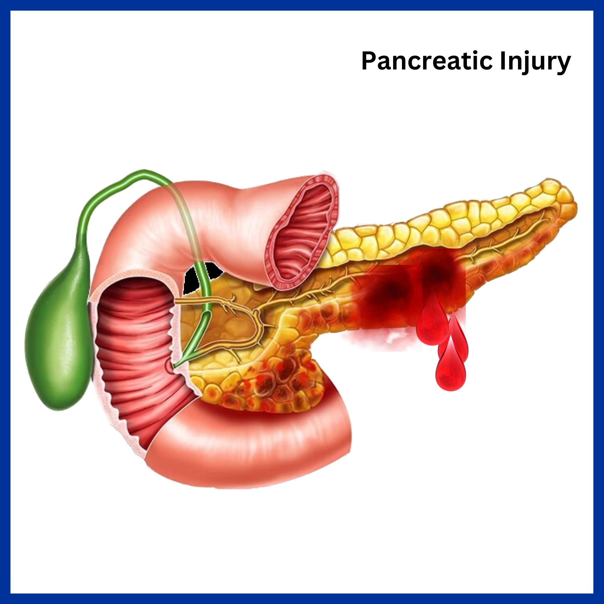 Pancreatic Injury
