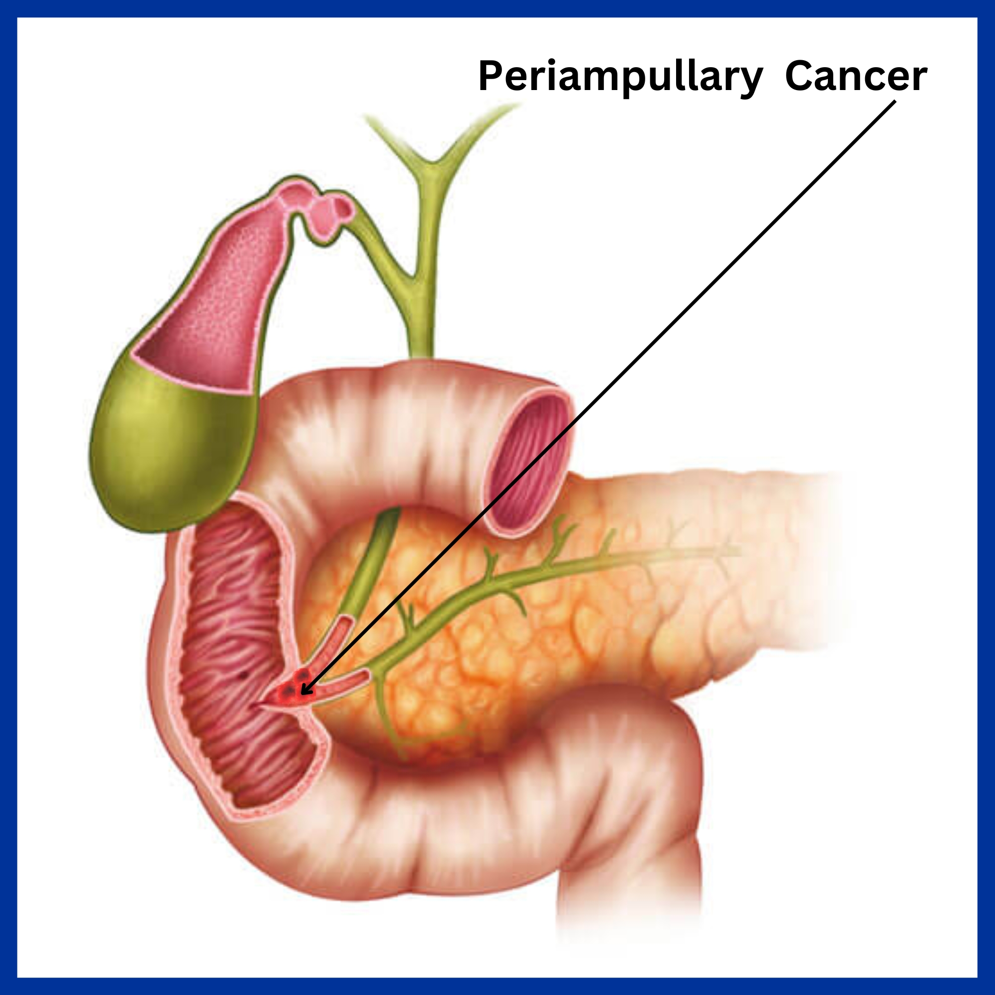 Periampullary Cancer