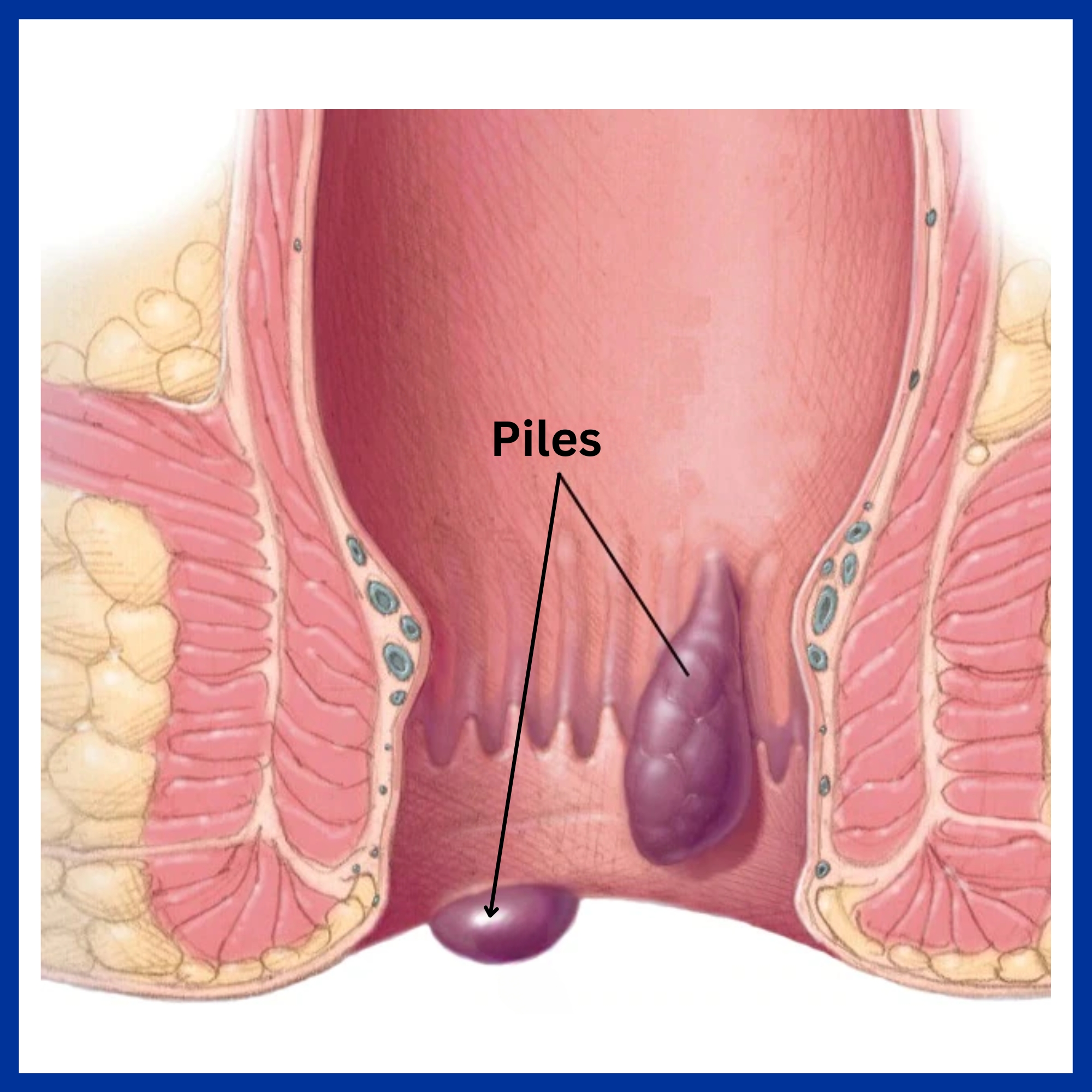 Haemorrhoids | Healthify