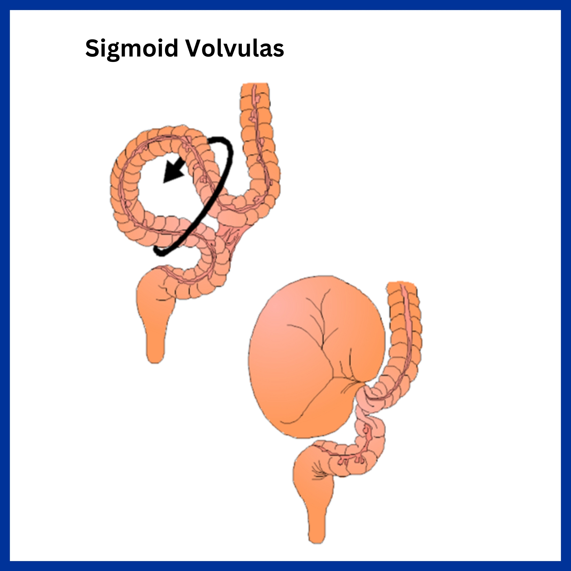 Sigmoid Volvulas