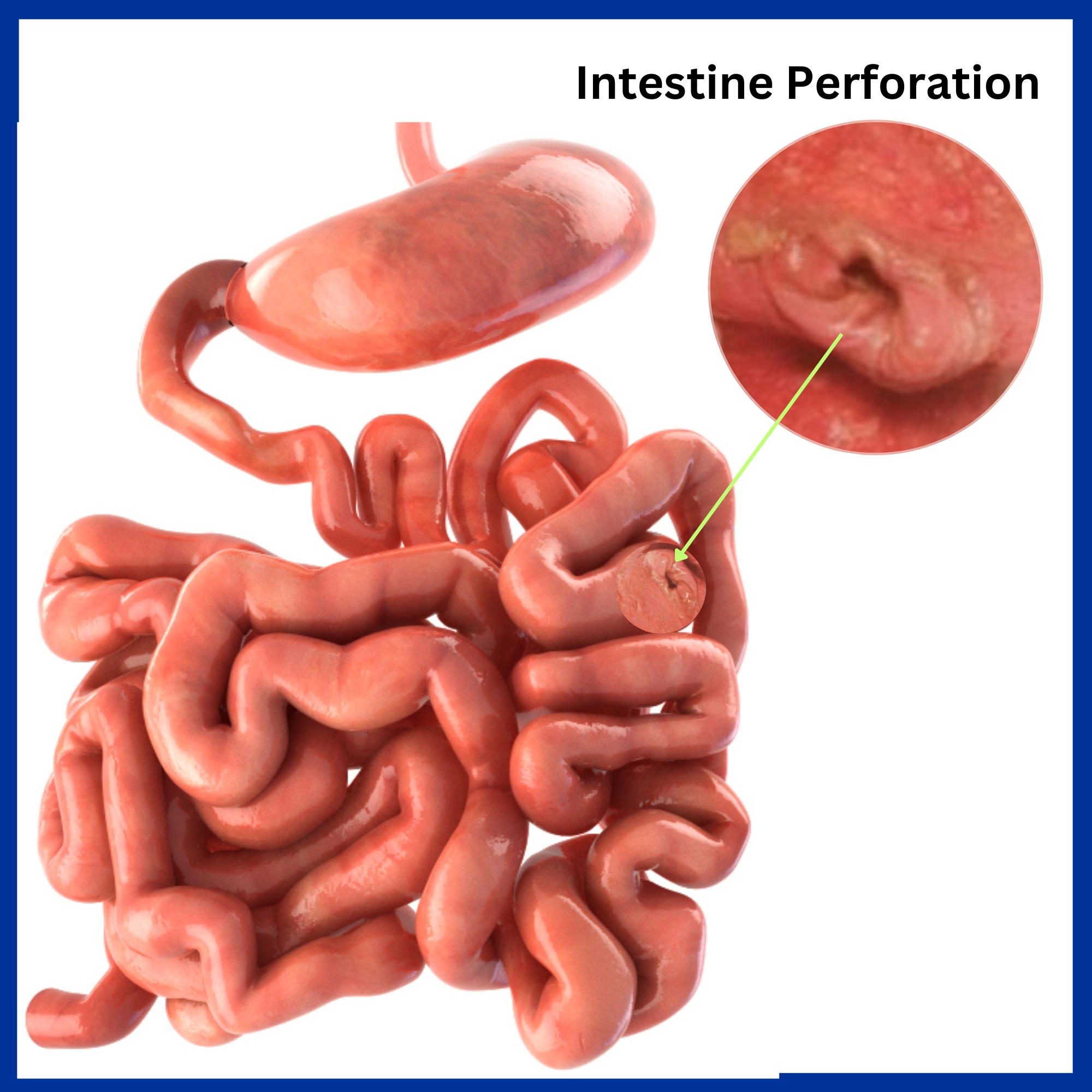 Small Intestine Perforation