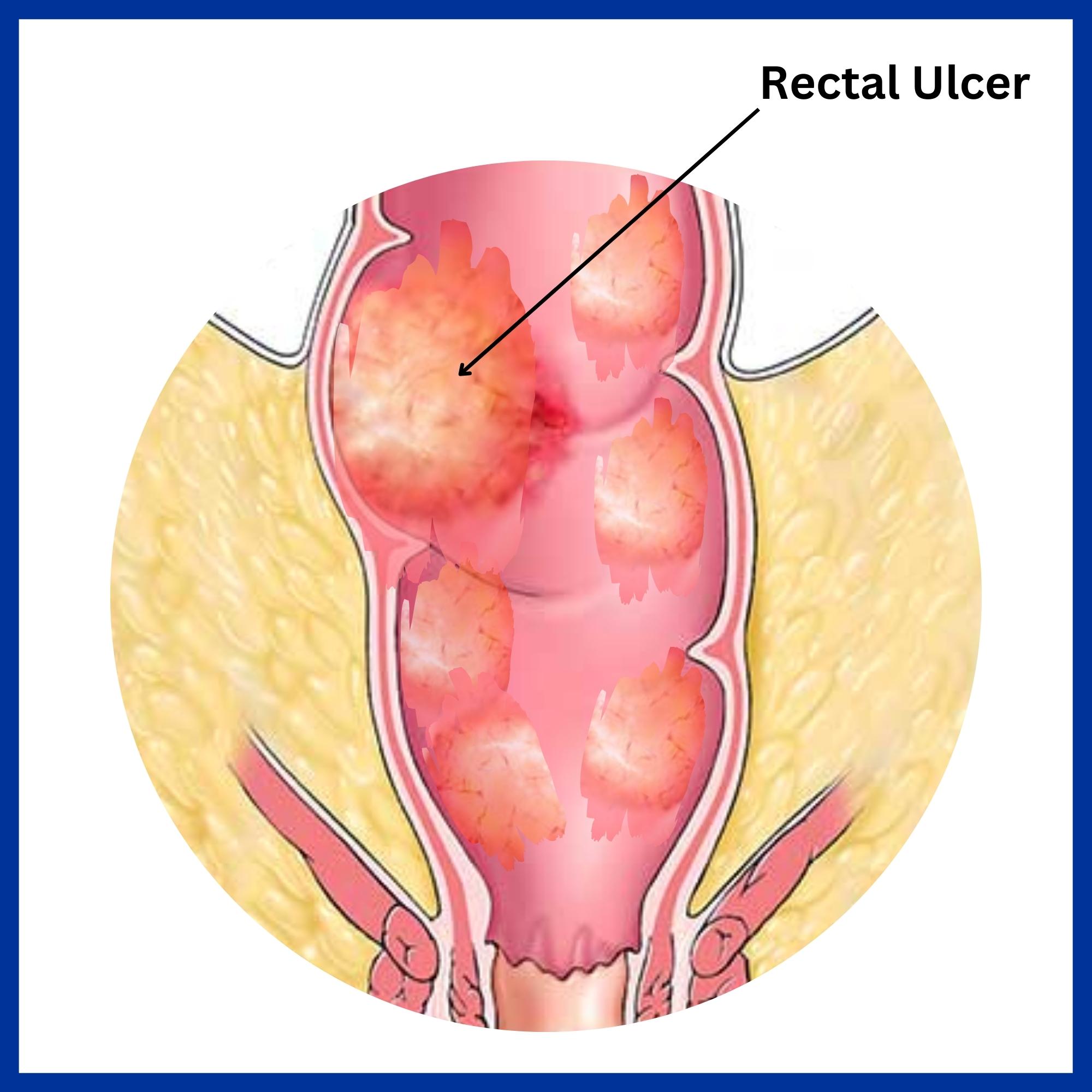 Solitary rectal ulcer syndrome (SRUS)