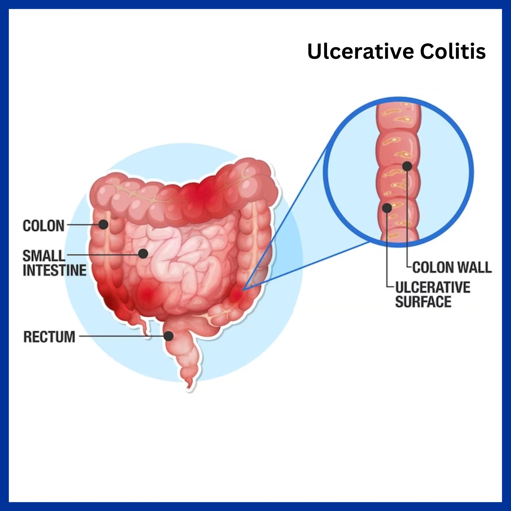 Ulcerative Colitis