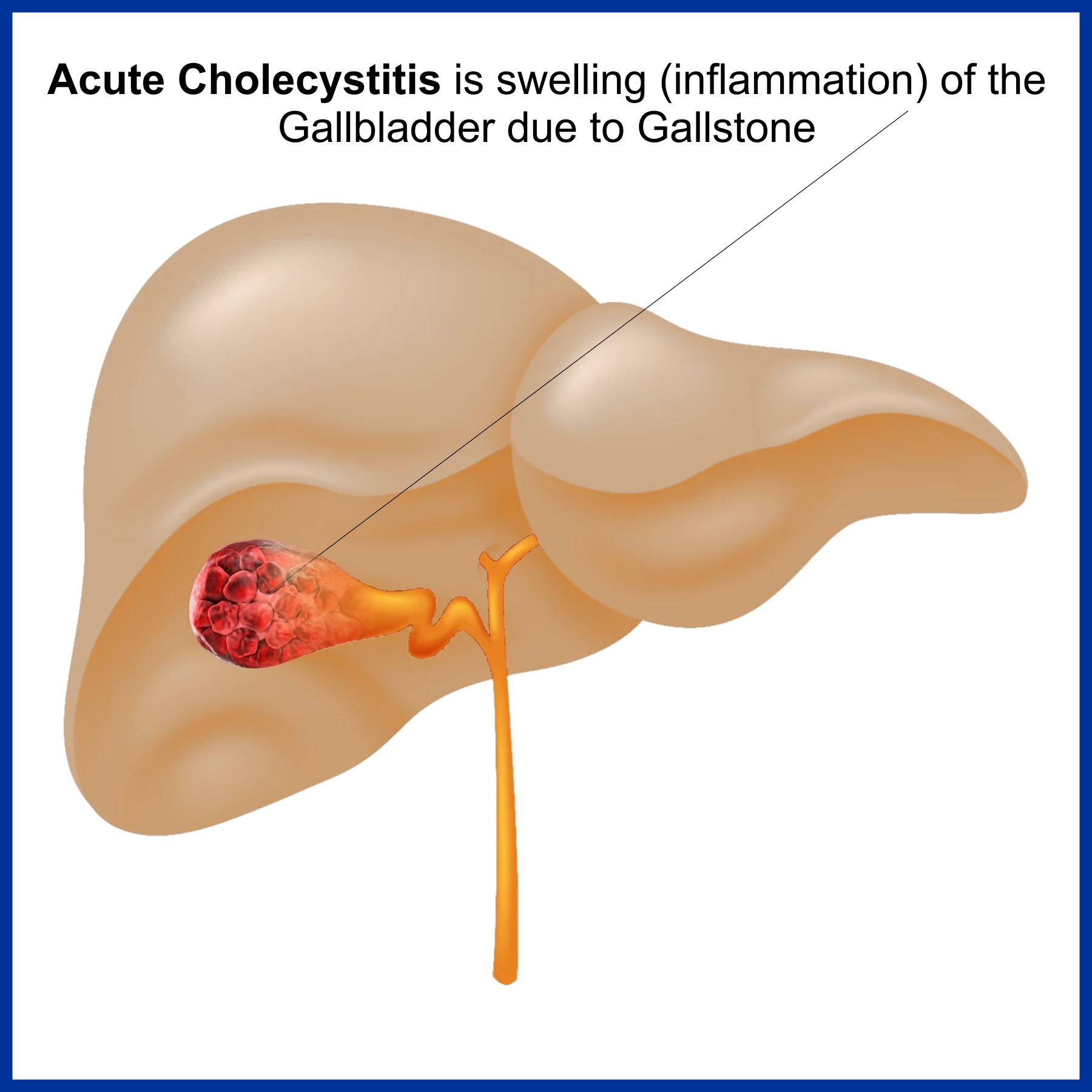 Acute Cholecystitis