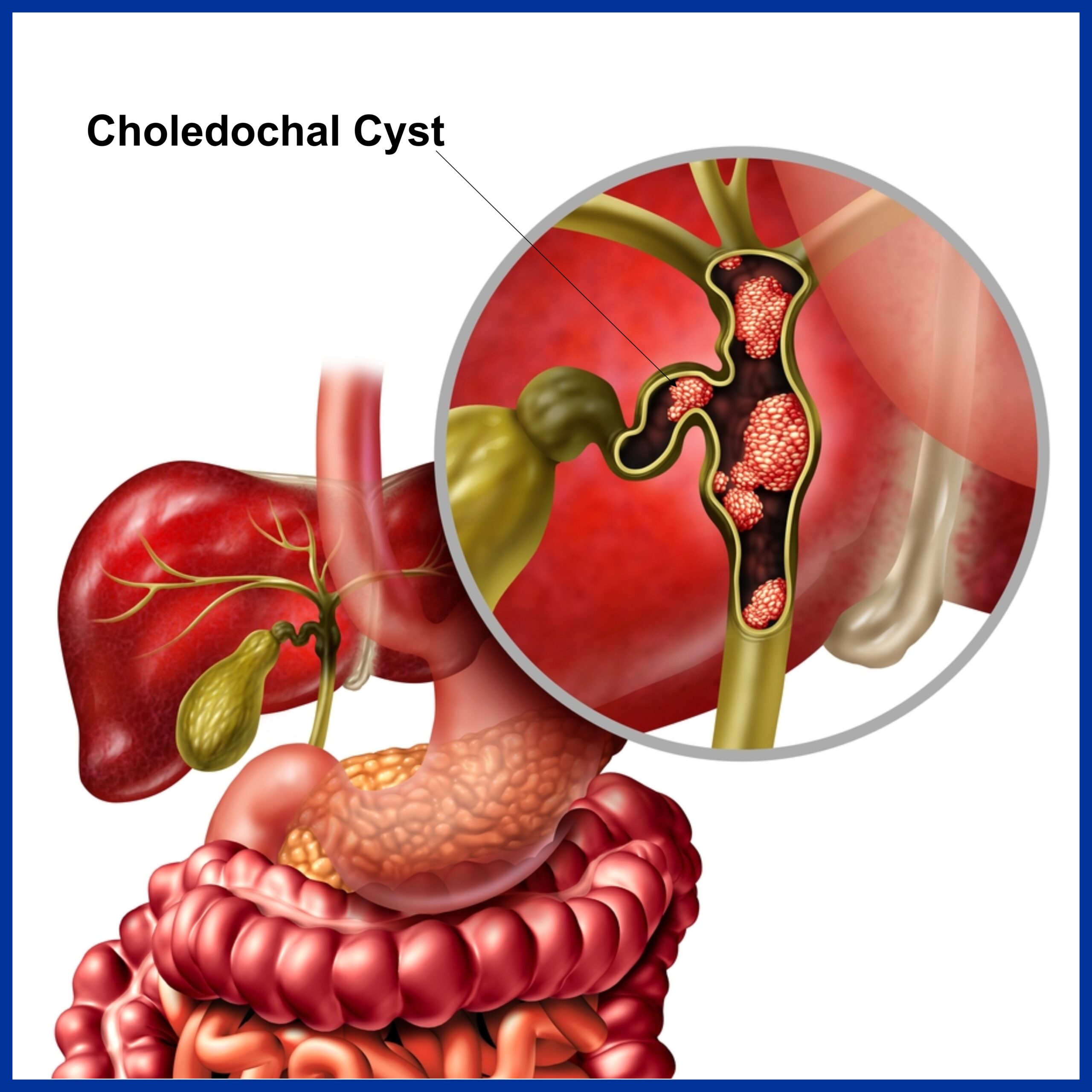 Choledochal Cyst