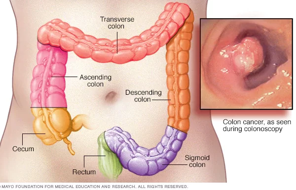 colon cancer
