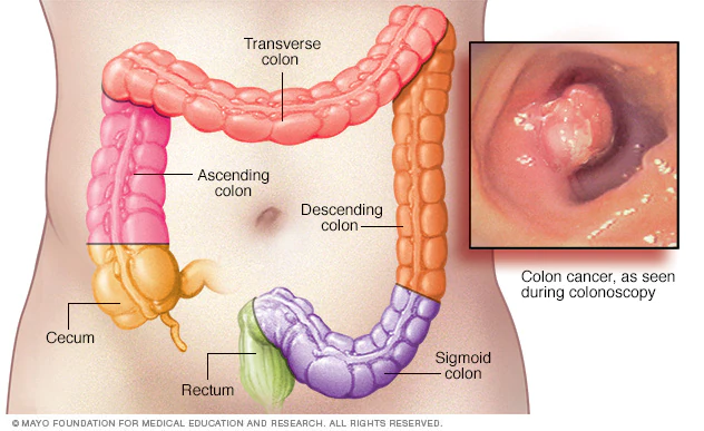Is colorectal cancer a lifestyle disease???