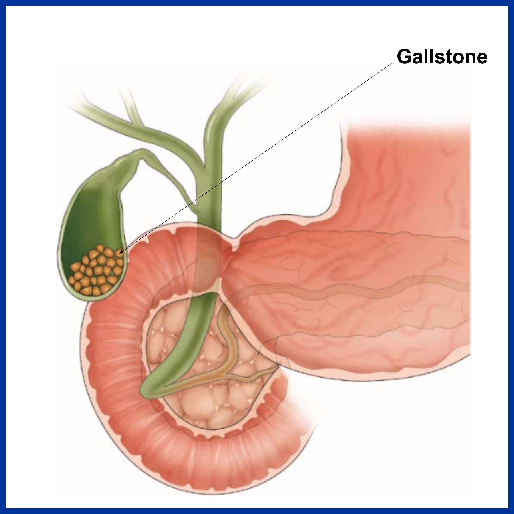 Gallstone Disease