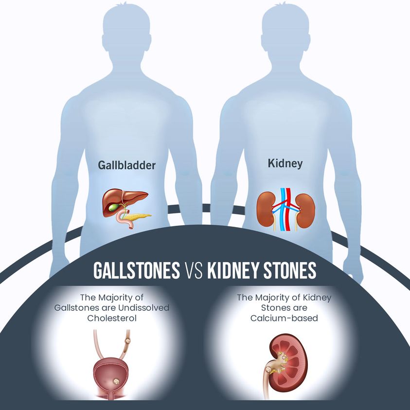 Gall stones versus Kidney stones