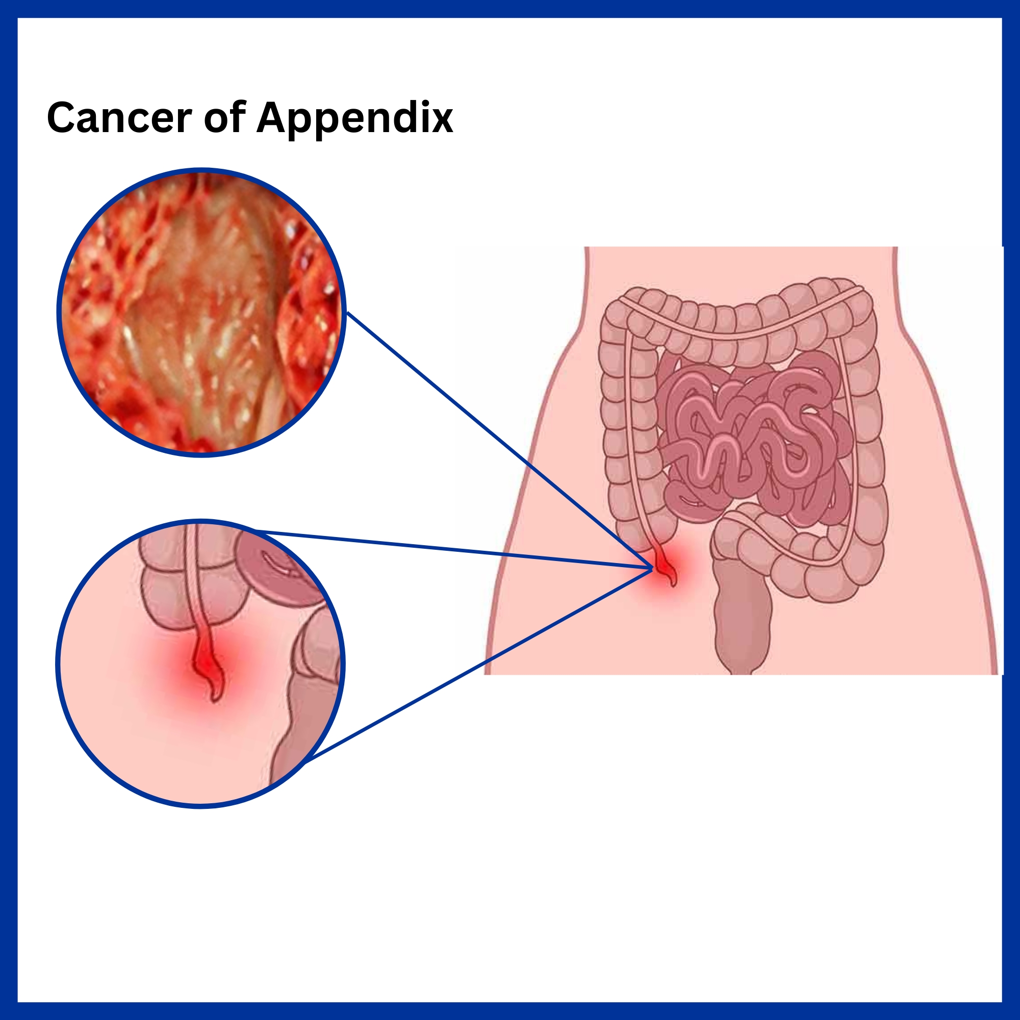 Cancer of Appendix