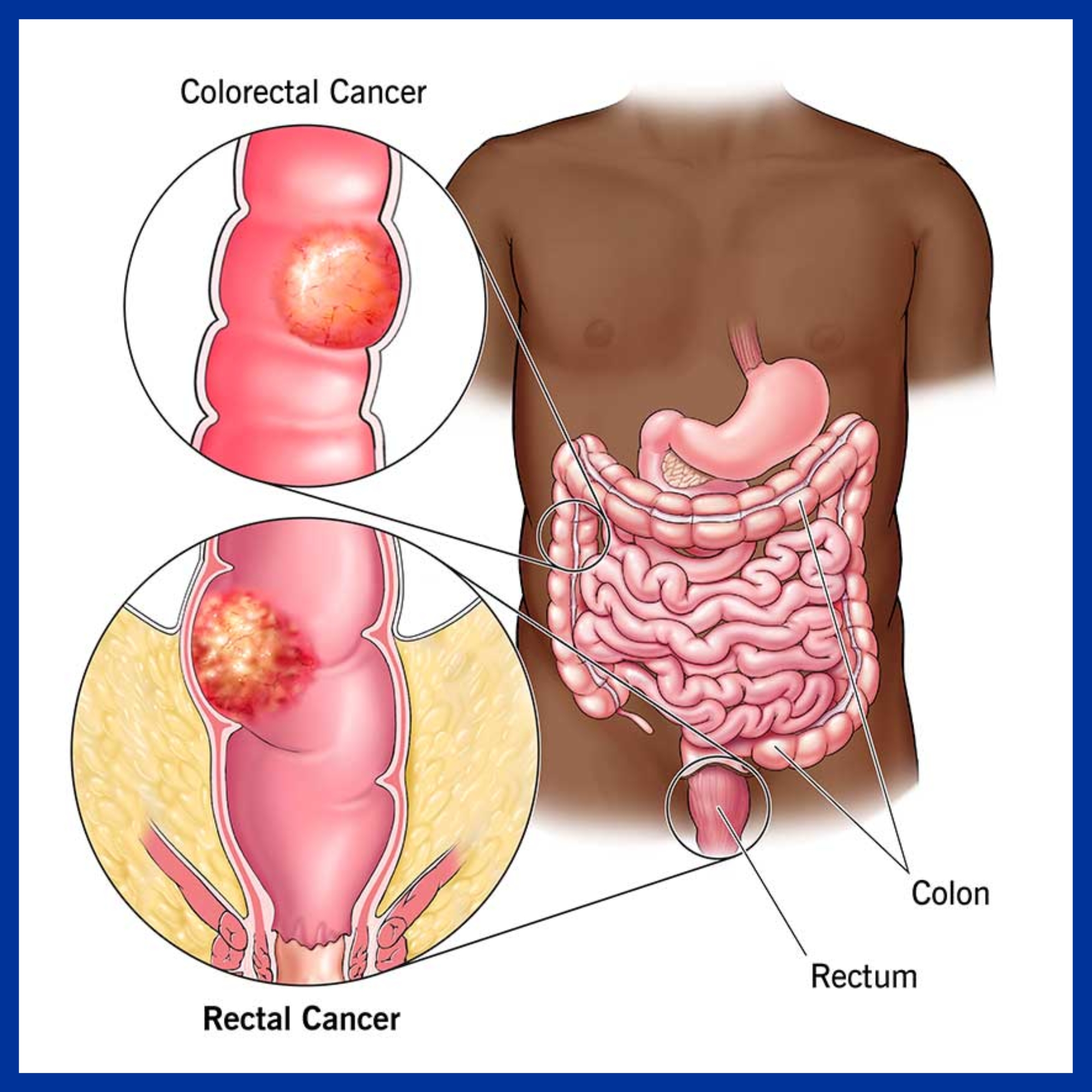 Cancer of Rectum