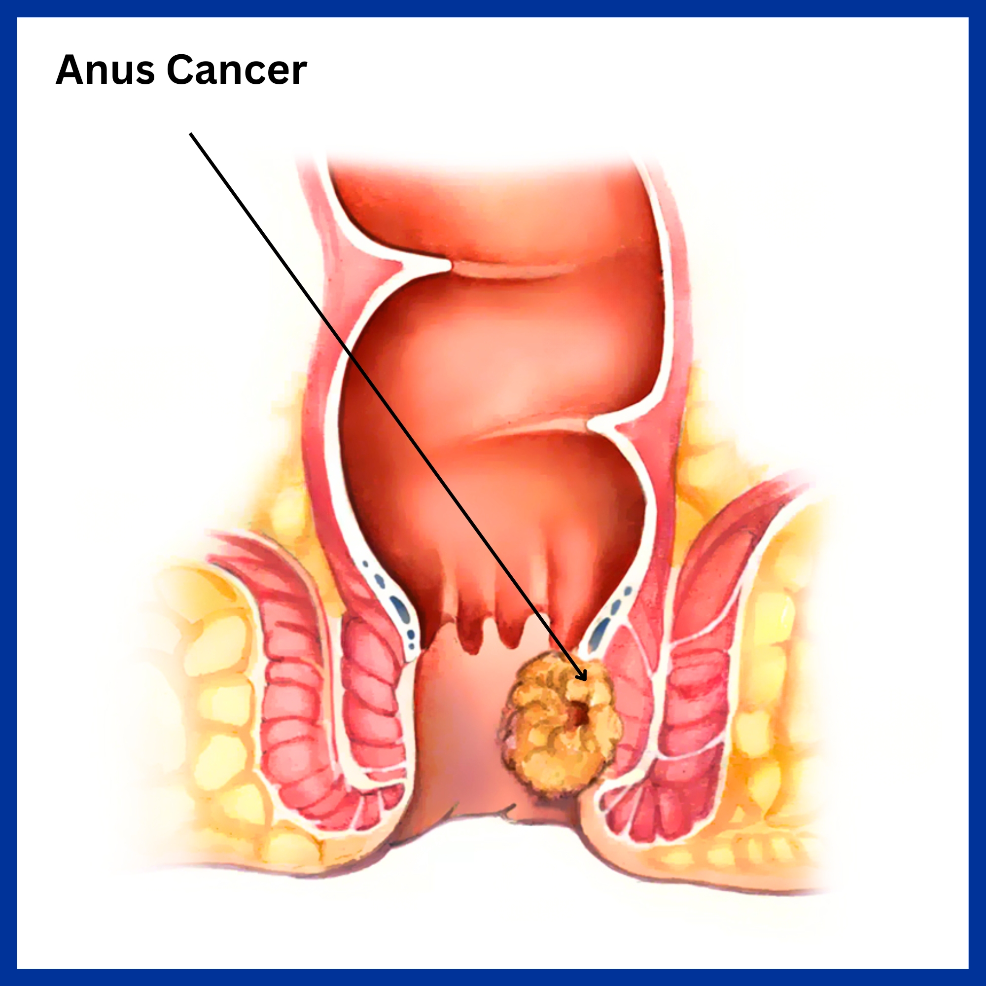 Cancer of Anus