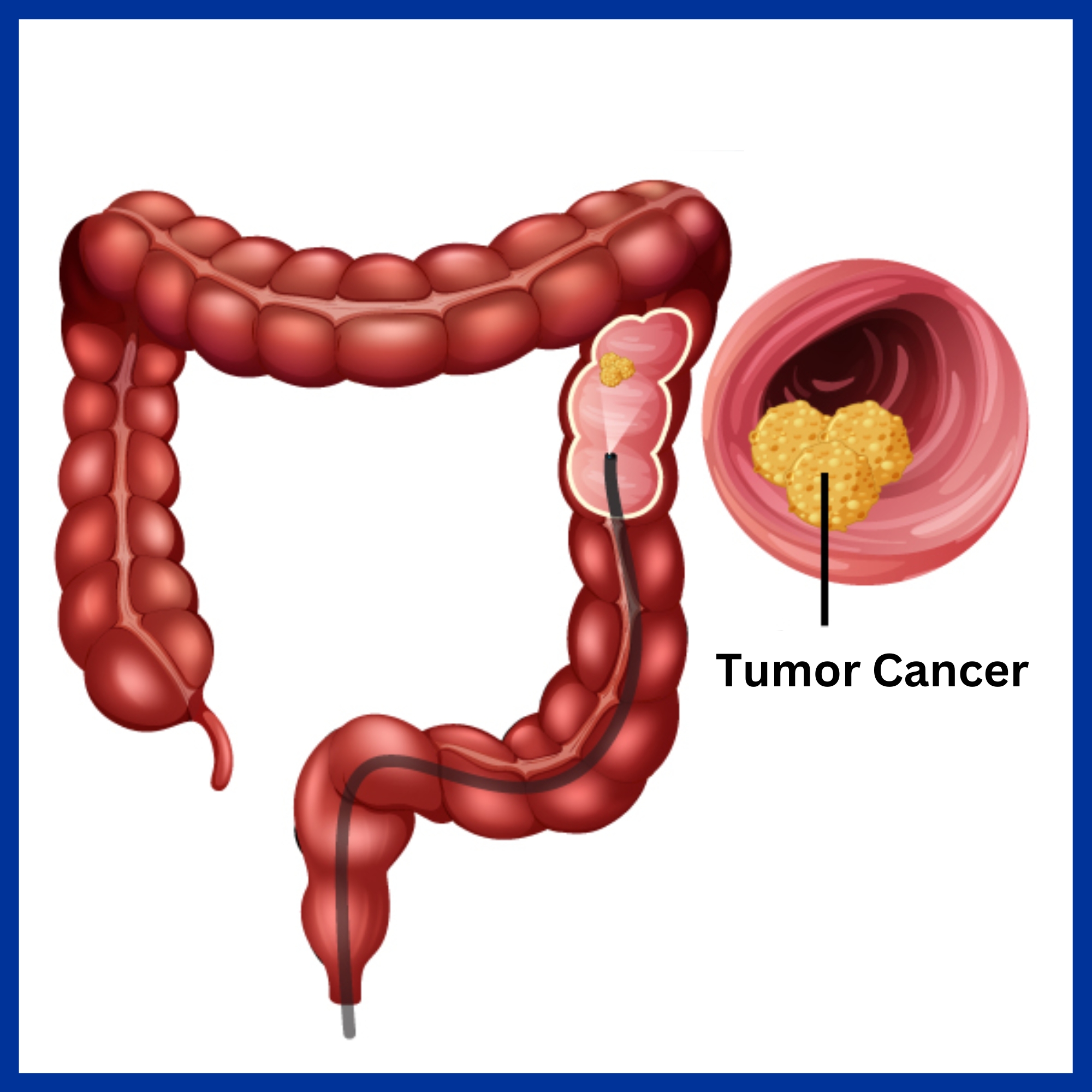 Cancer of Large Intestine